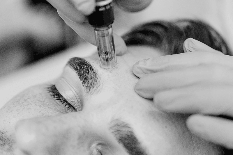 Man Getting Microneedling At MedSpa
