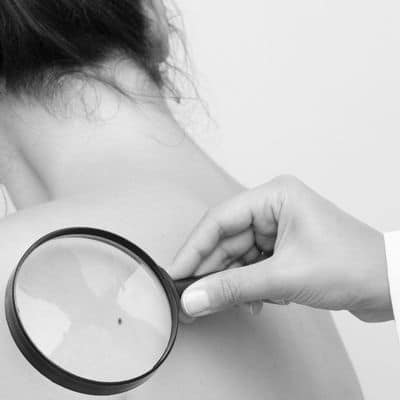 mohs surgery dr burke