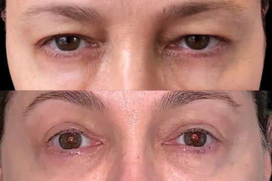Before and After Image: Blepharoplasty - front