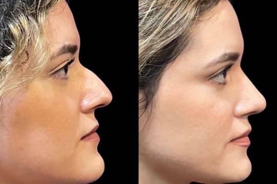 Before and After Image: Rhinoplasty - front