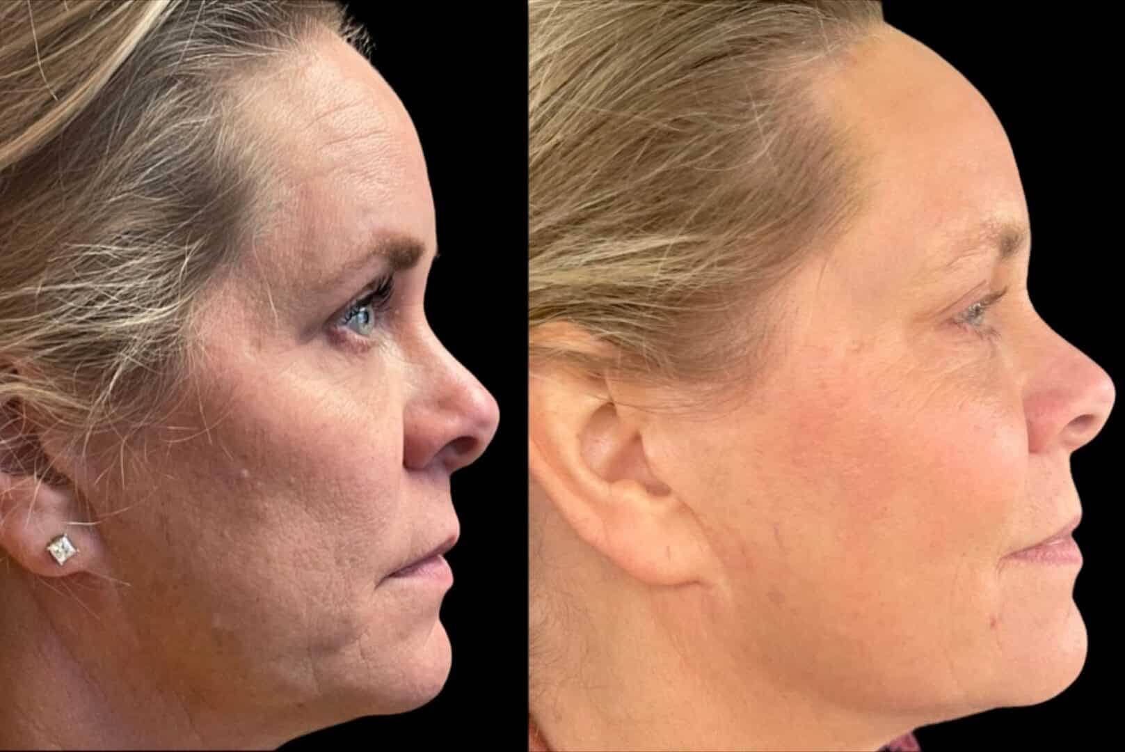 Before and After Image: HALO - front
