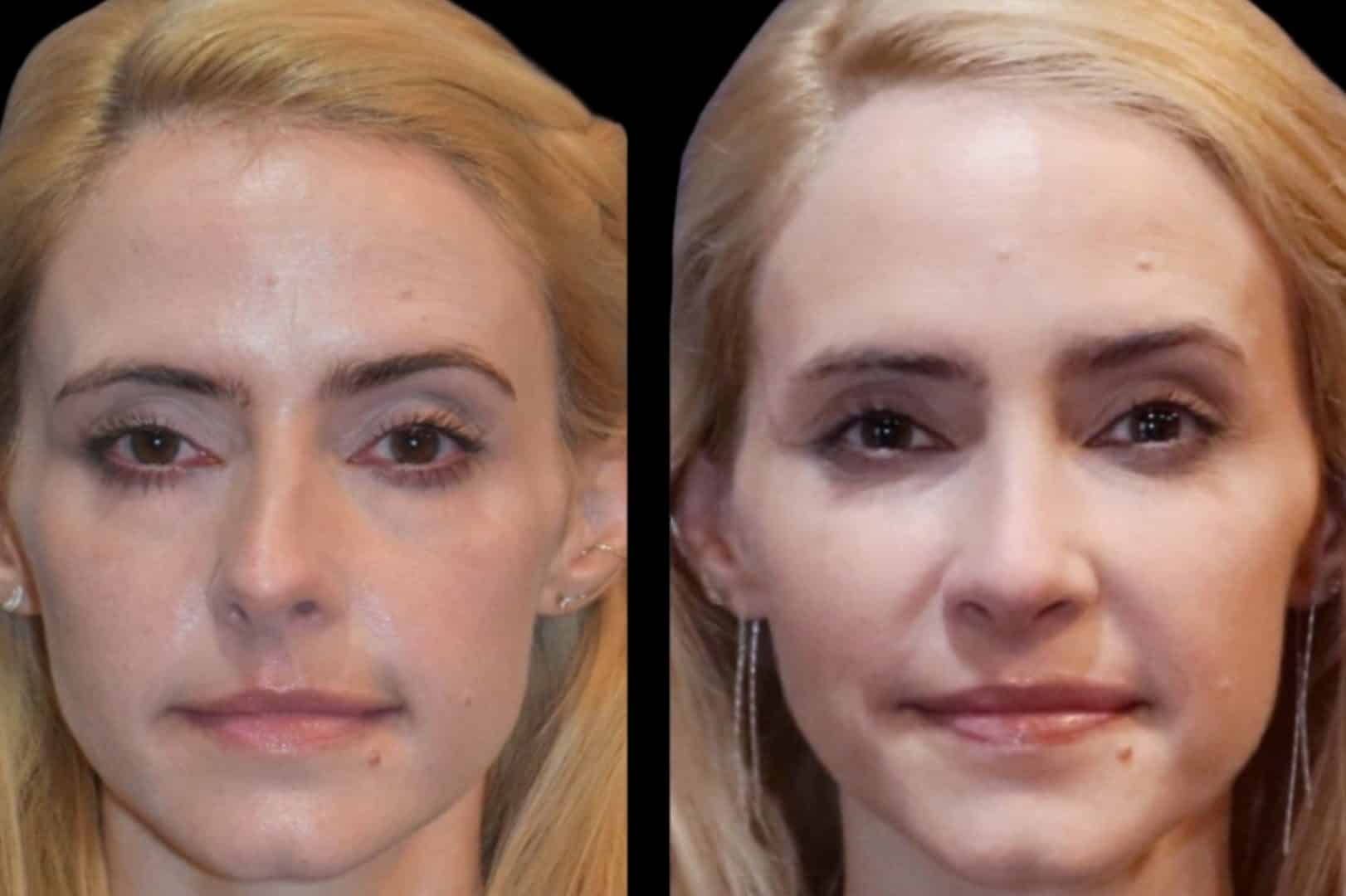 Before and After Image: Rhinoplasty - front