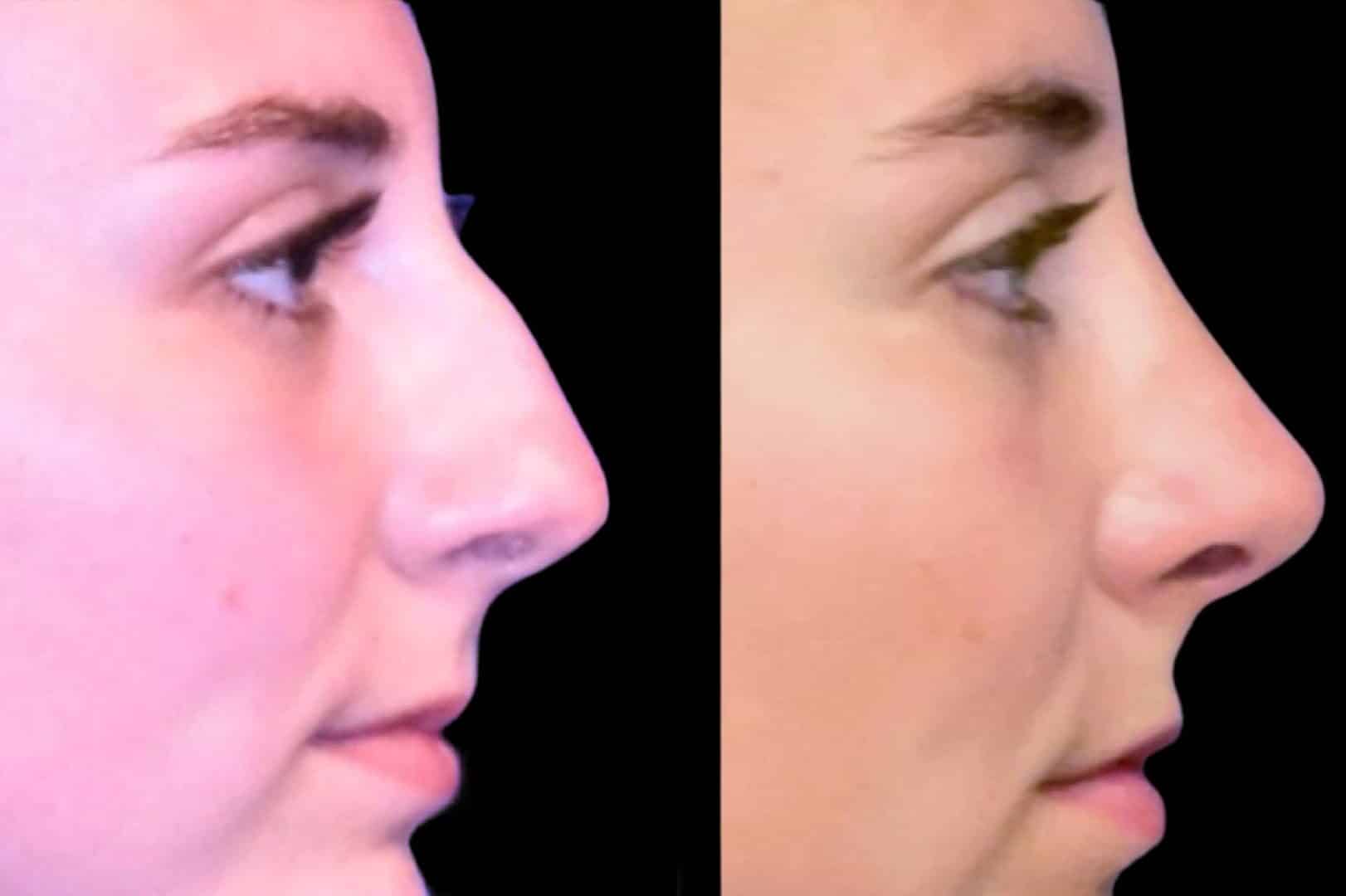 Before and After Image: Rhinoplasty - front