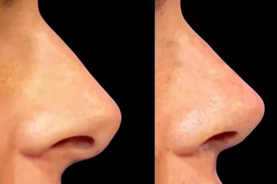Before and After Image: Rhinoplasty - front