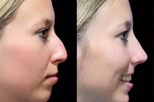 Before and After Image: Rhinoplasty - front