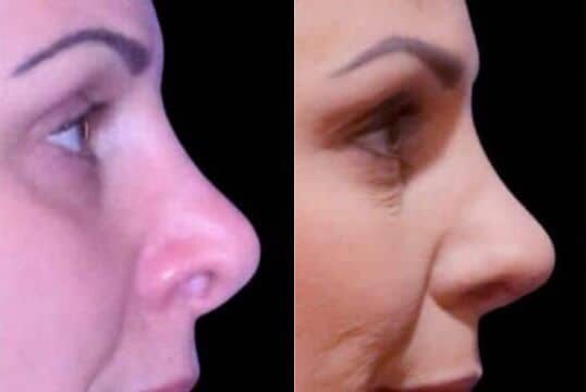 Before and After Image: Rhinoplasty - front