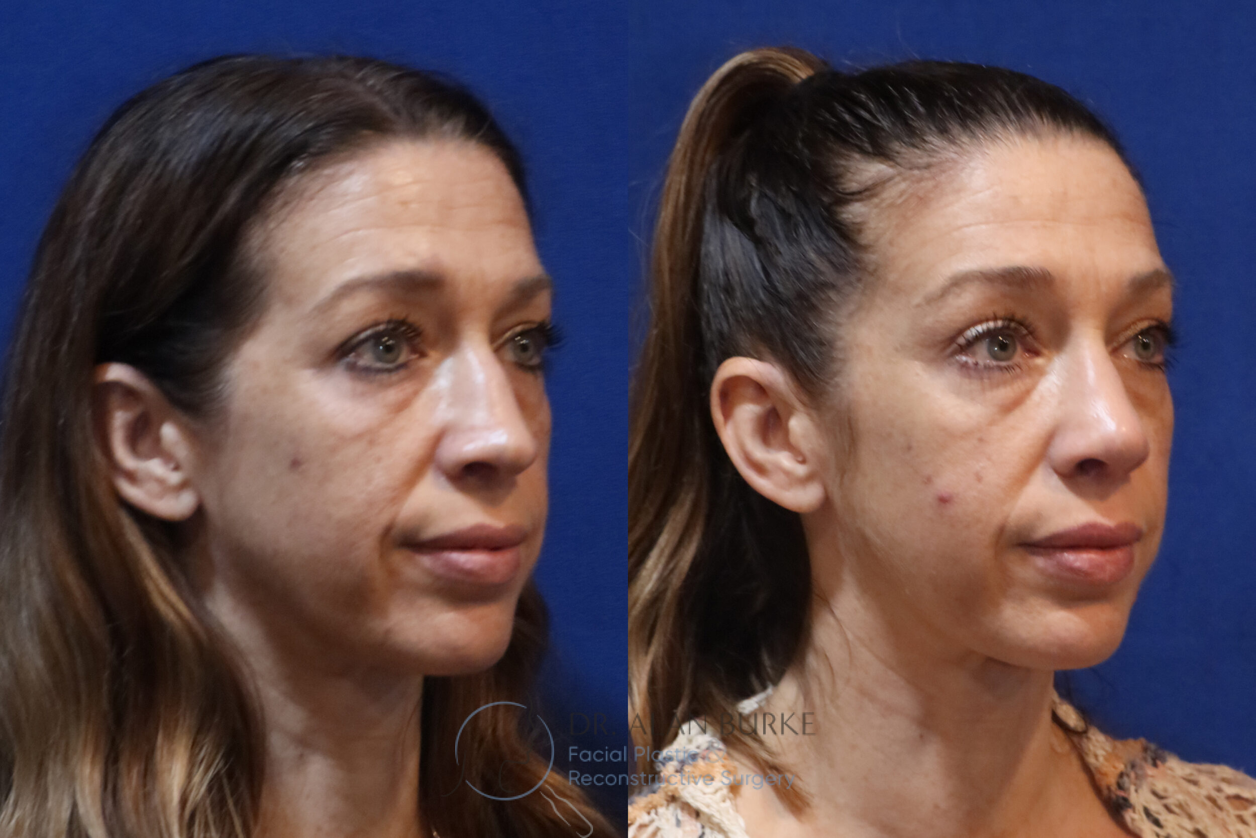 Before and After Image: Rhinoplasty - right-front-oblique