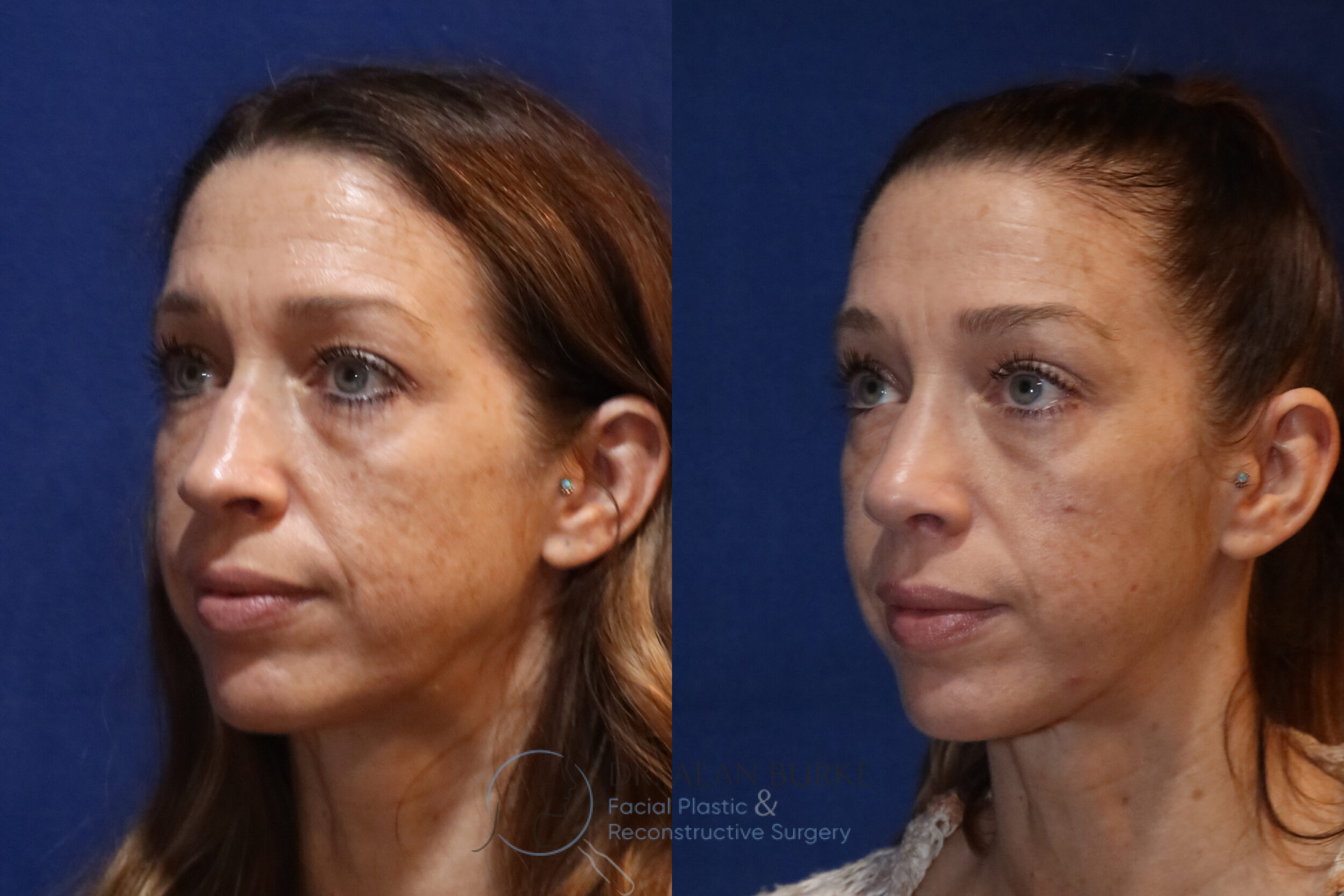 Before and After Image: Rhinoplasty - left-front-oblique