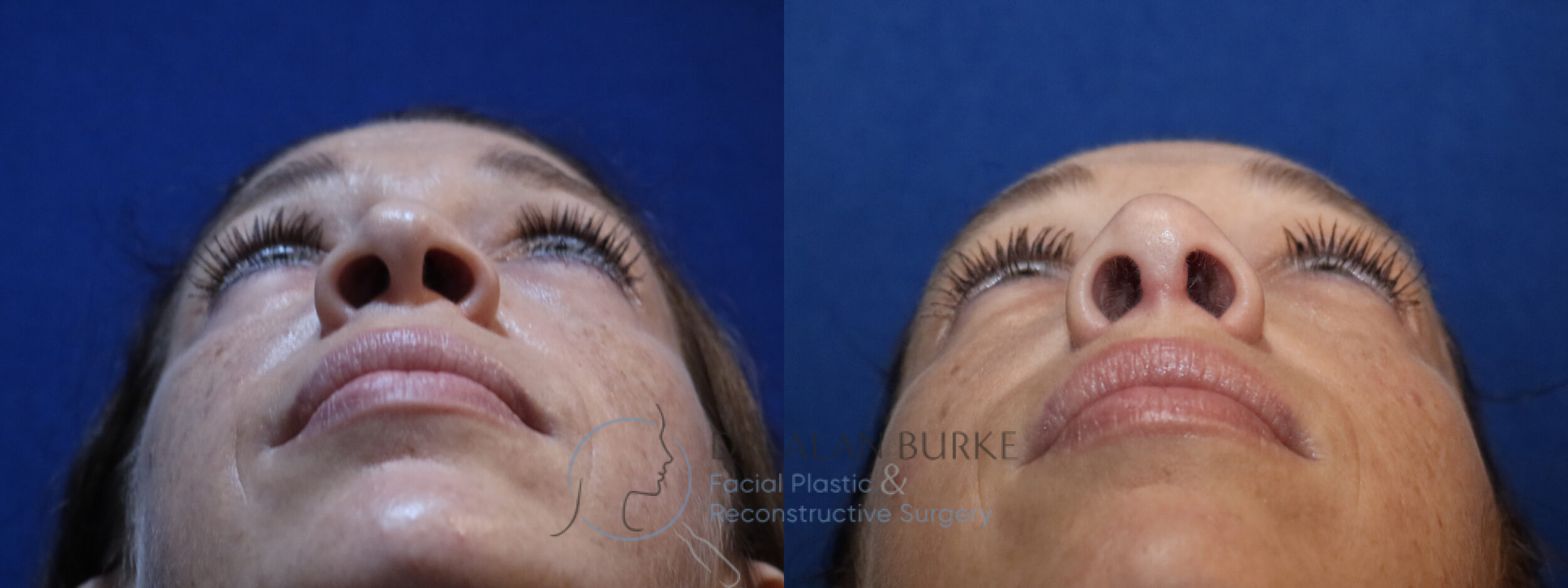 Before and After Image: Rhinoplasty - other