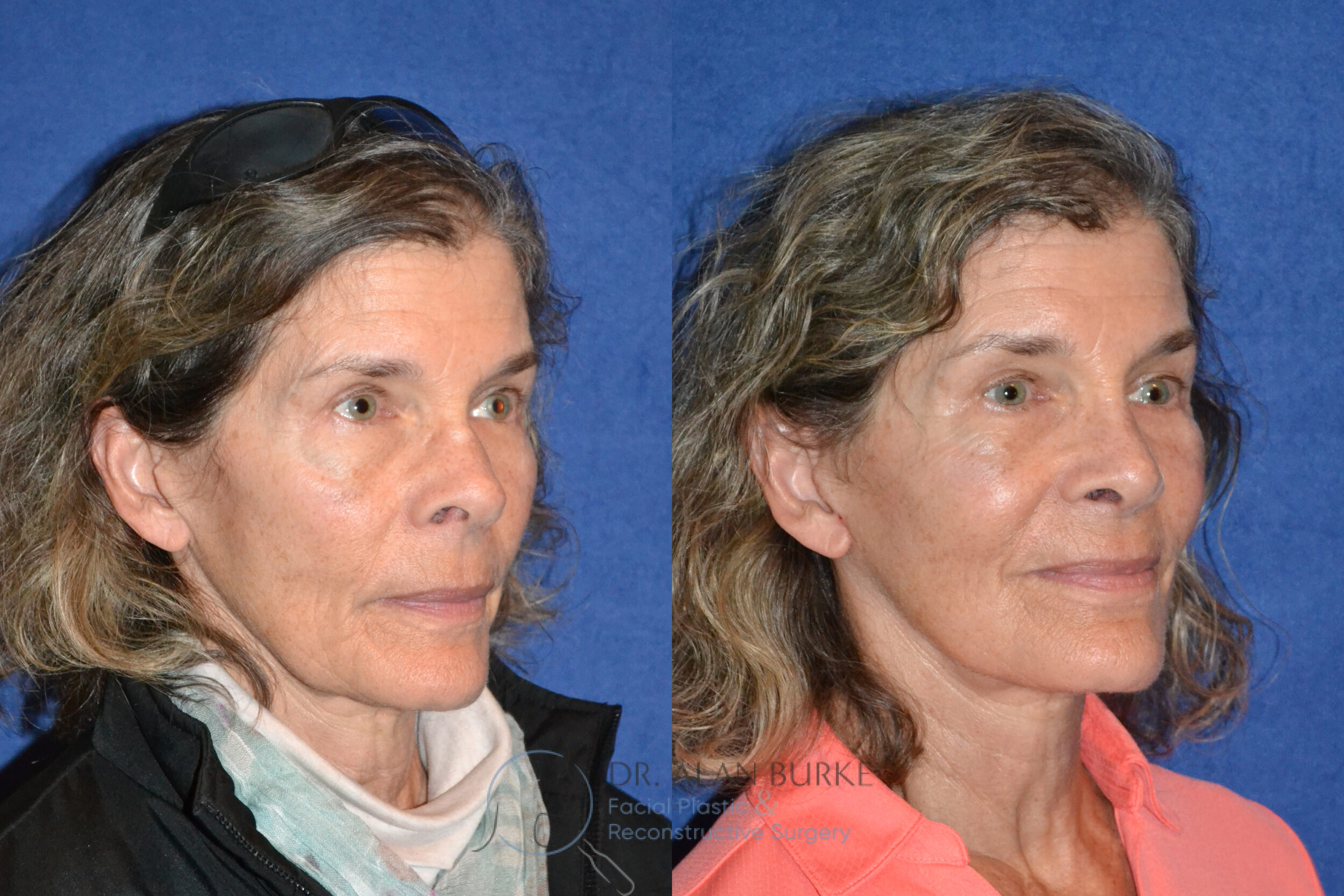 Before and After Image: Rhinoplasty - right-front-oblique