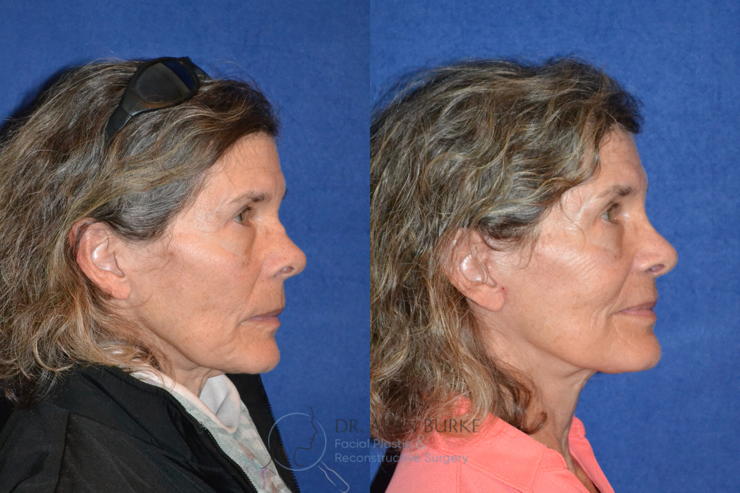 Before and After Image: Rhinoplasty - right-side