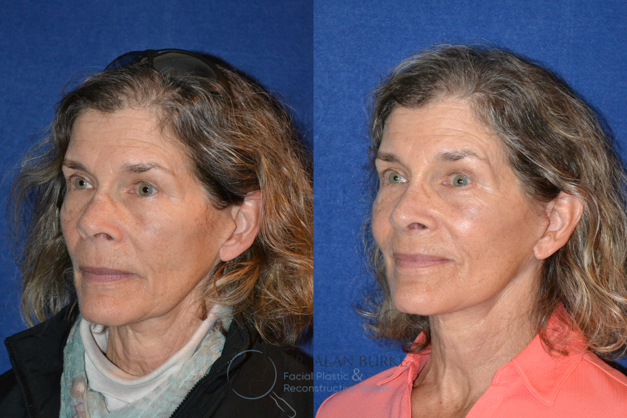 Before and After Image: Rhinoplasty - left-front-oblique