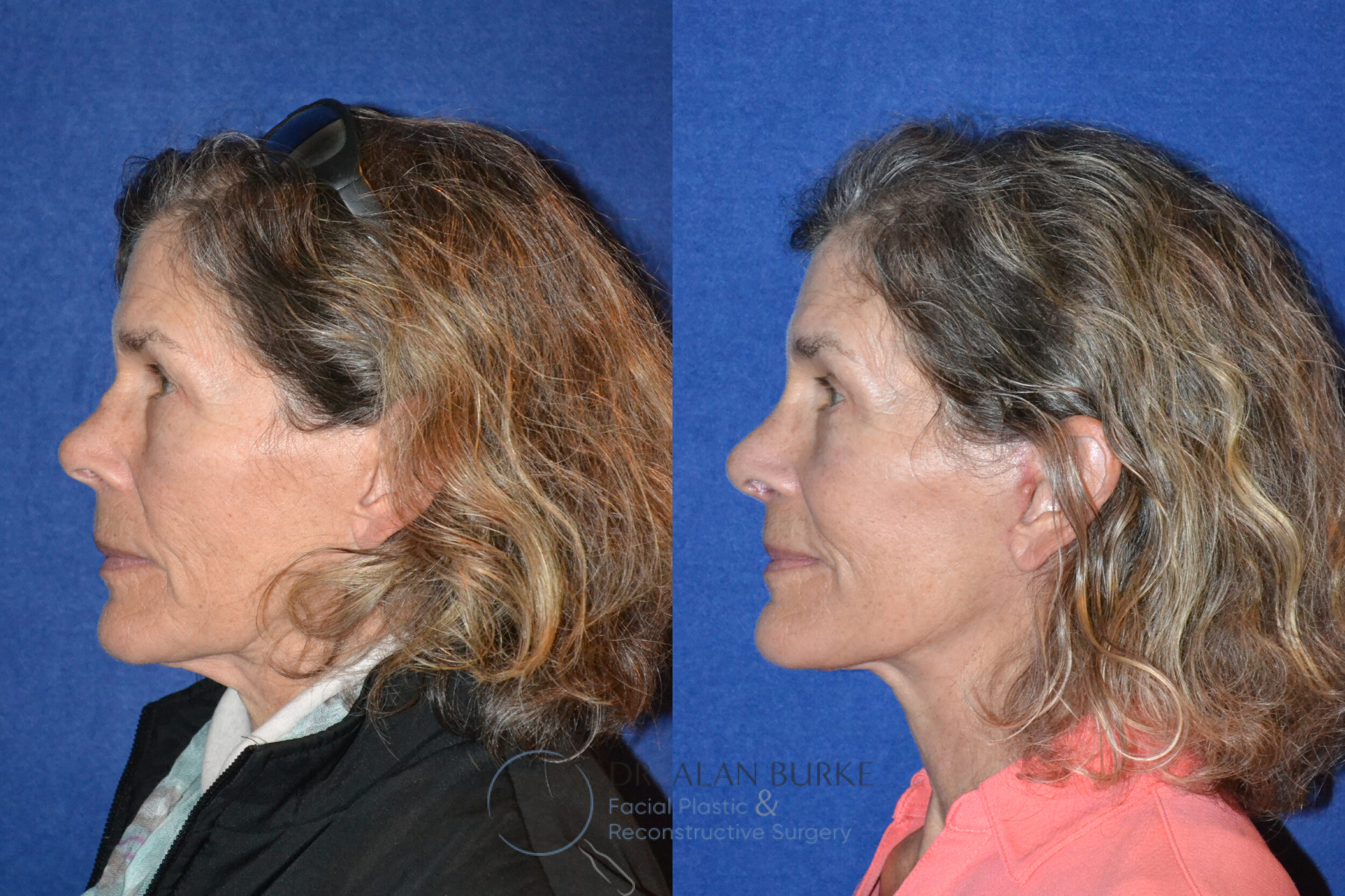 Before and After Image: Rhinoplasty - left-side