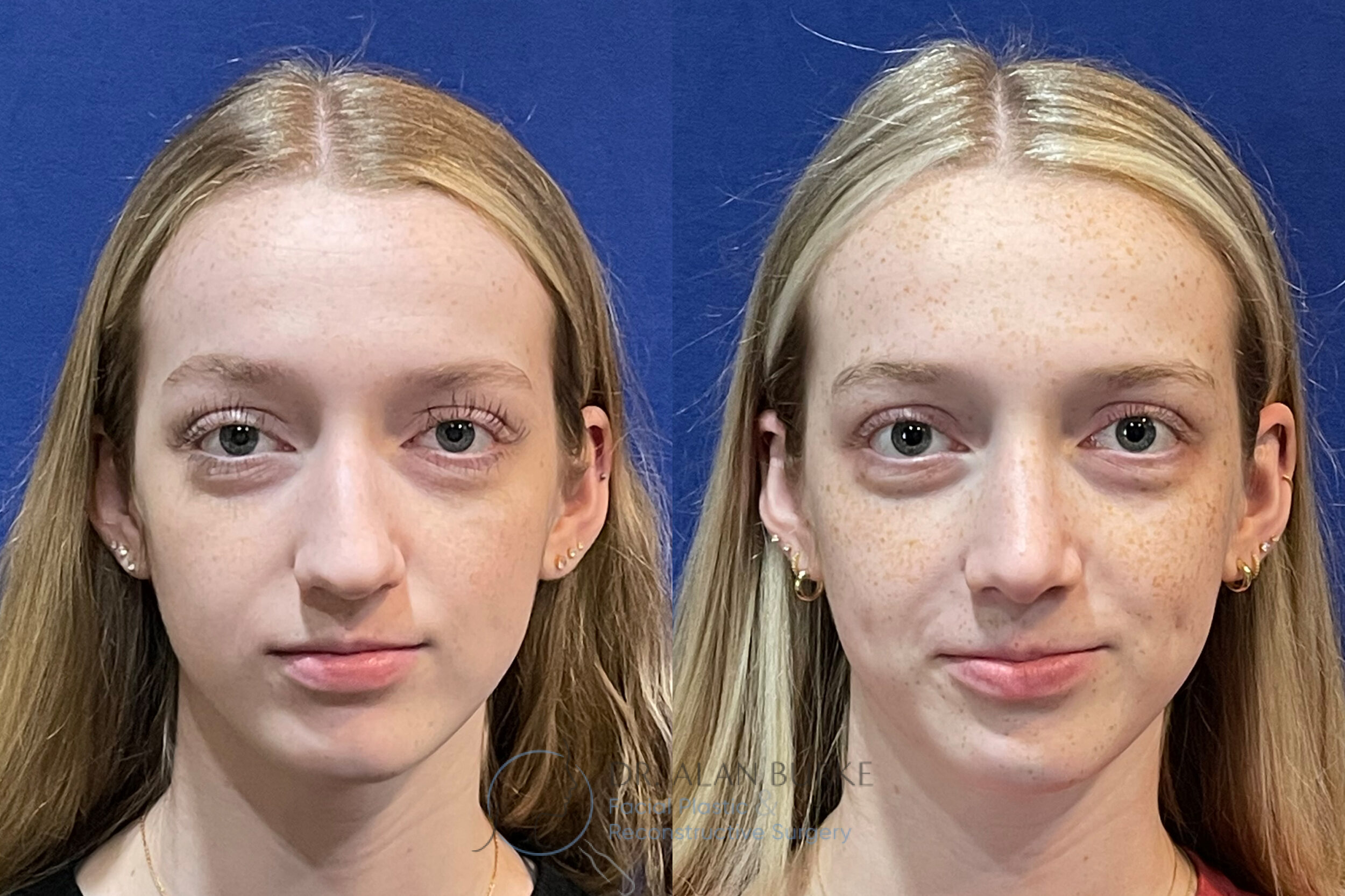 Before and After Image: Rhinoplasty - front
