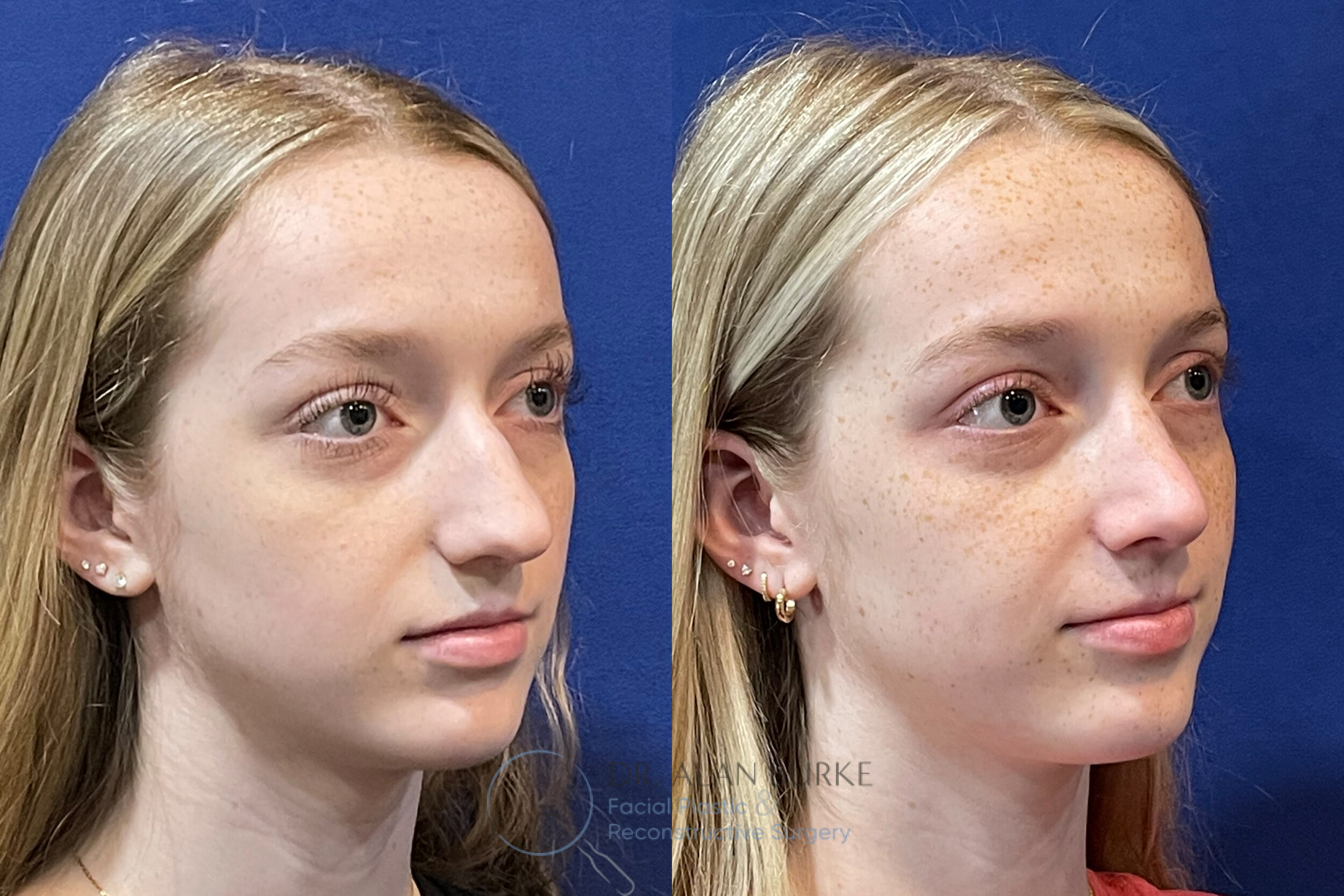 Before and After Image: Rhinoplasty - right-front-oblique