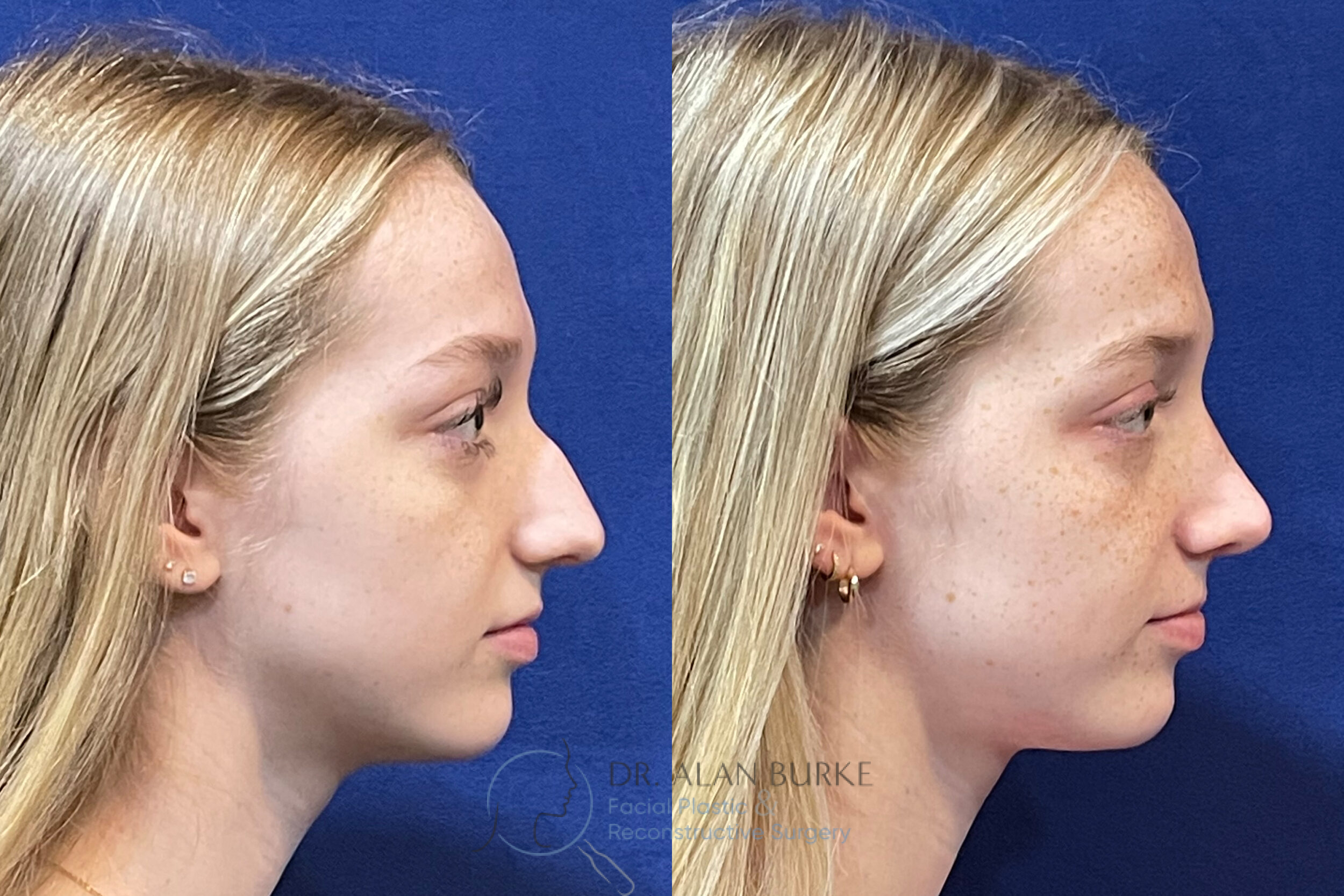 Before and After Image: Rhinoplasty - right-side