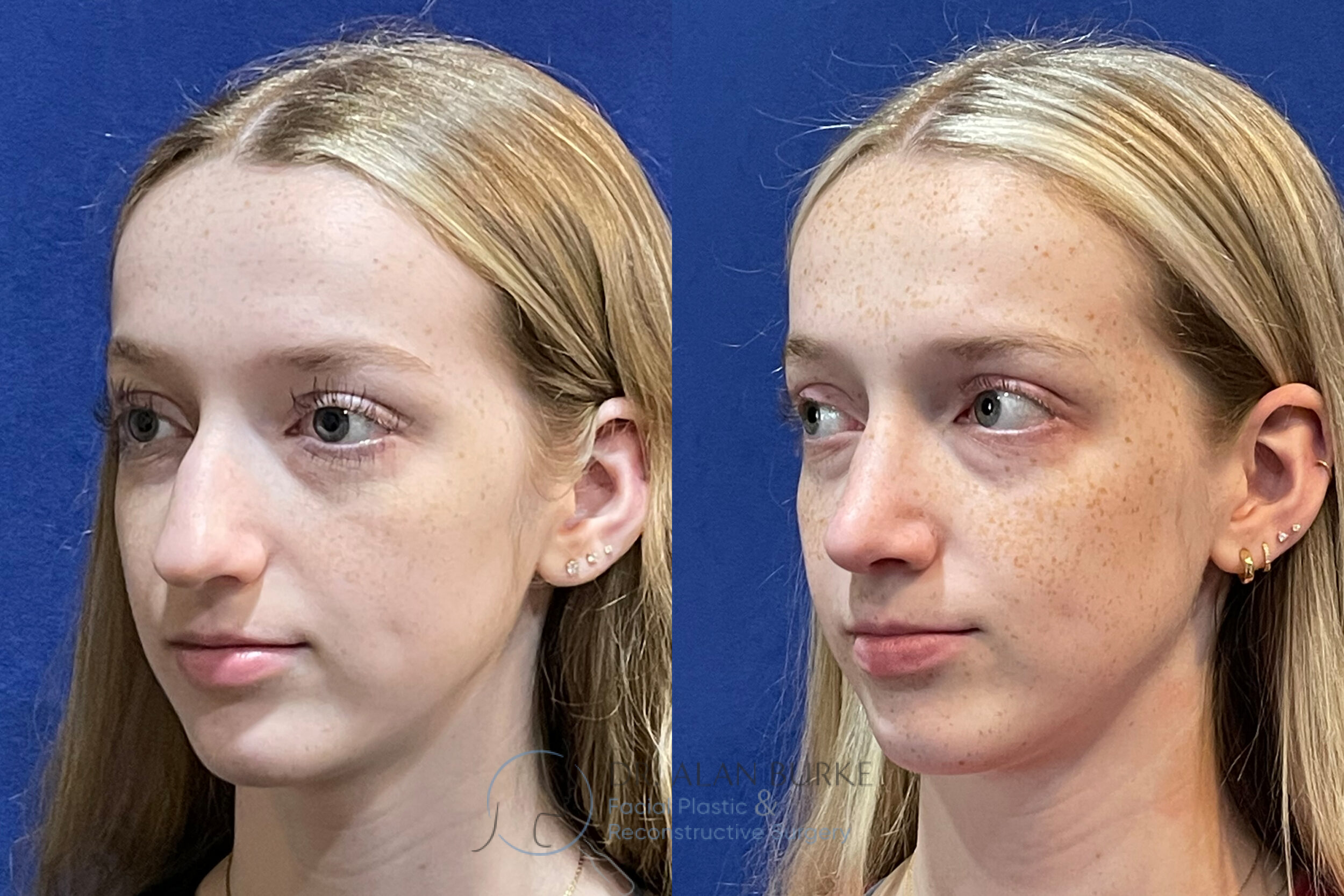 Before and After Image: Rhinoplasty - left-front-oblique