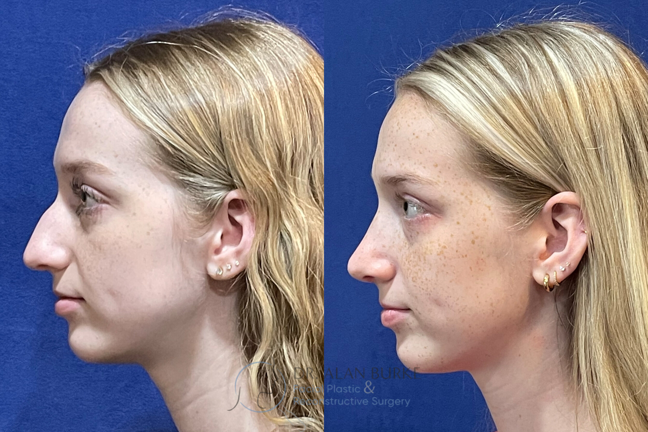 Before and After Image: Rhinoplasty - left-side