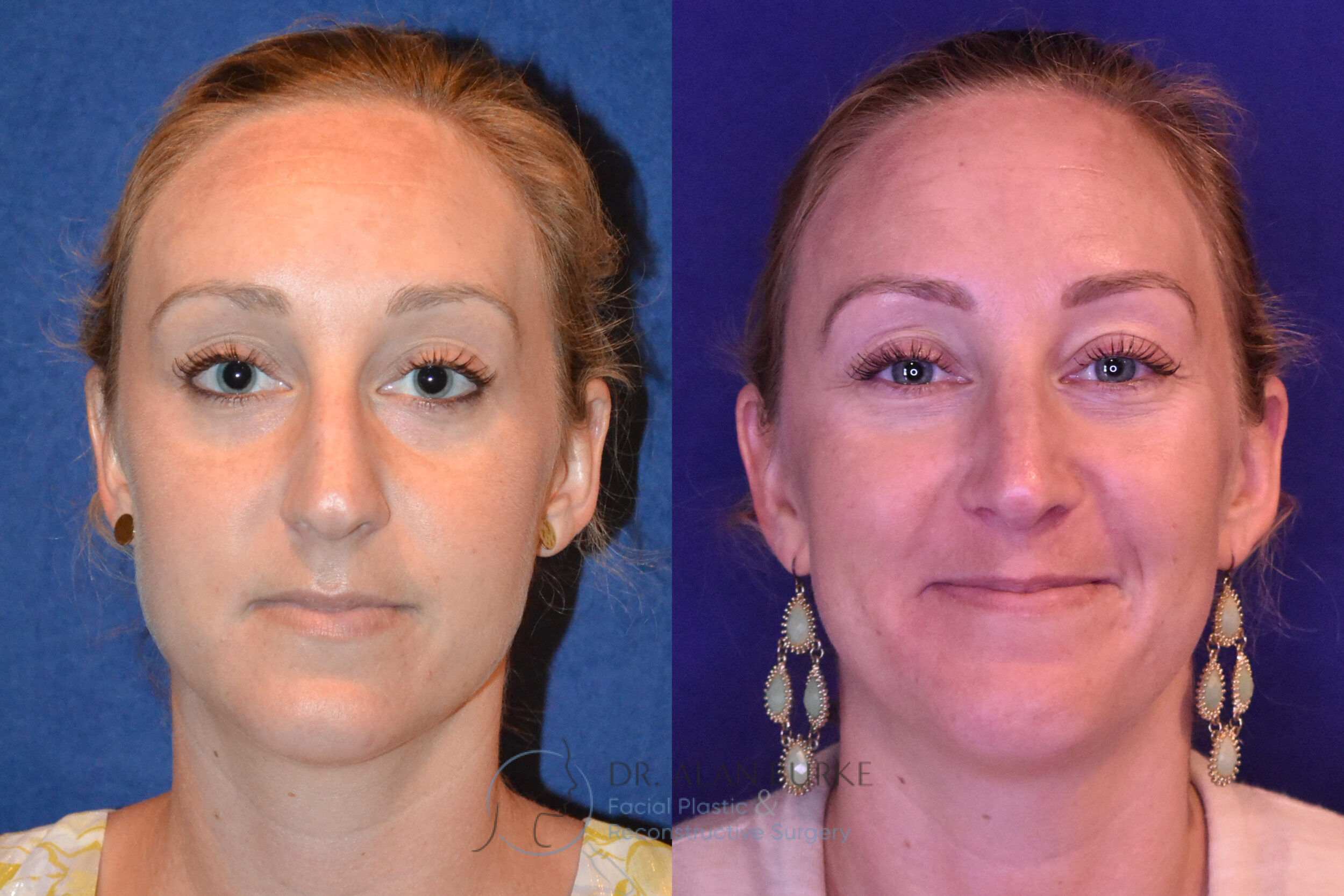 Before and After Image: Rhinoplasty - front