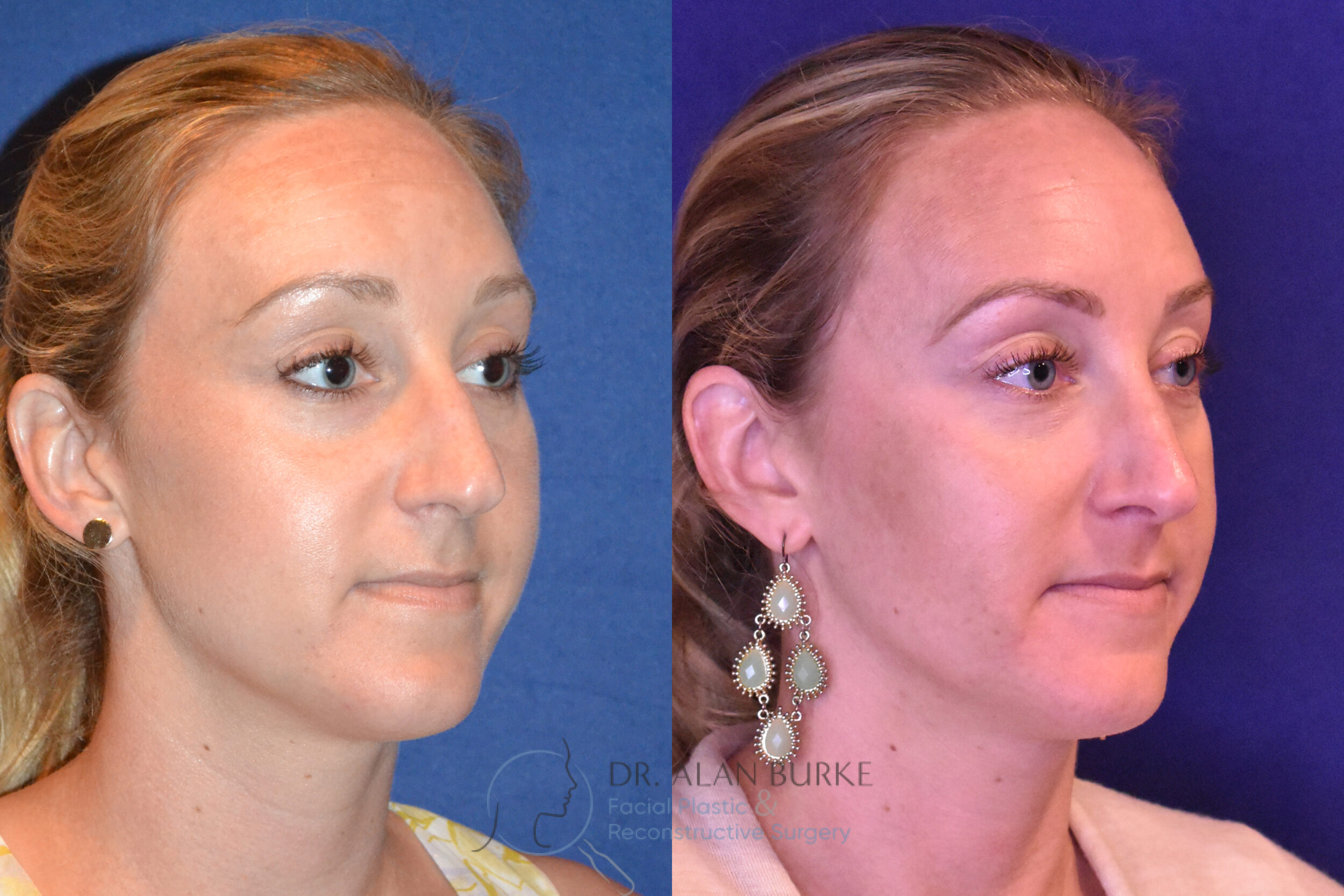 Before and After Image: Rhinoplasty - right-front-oblique