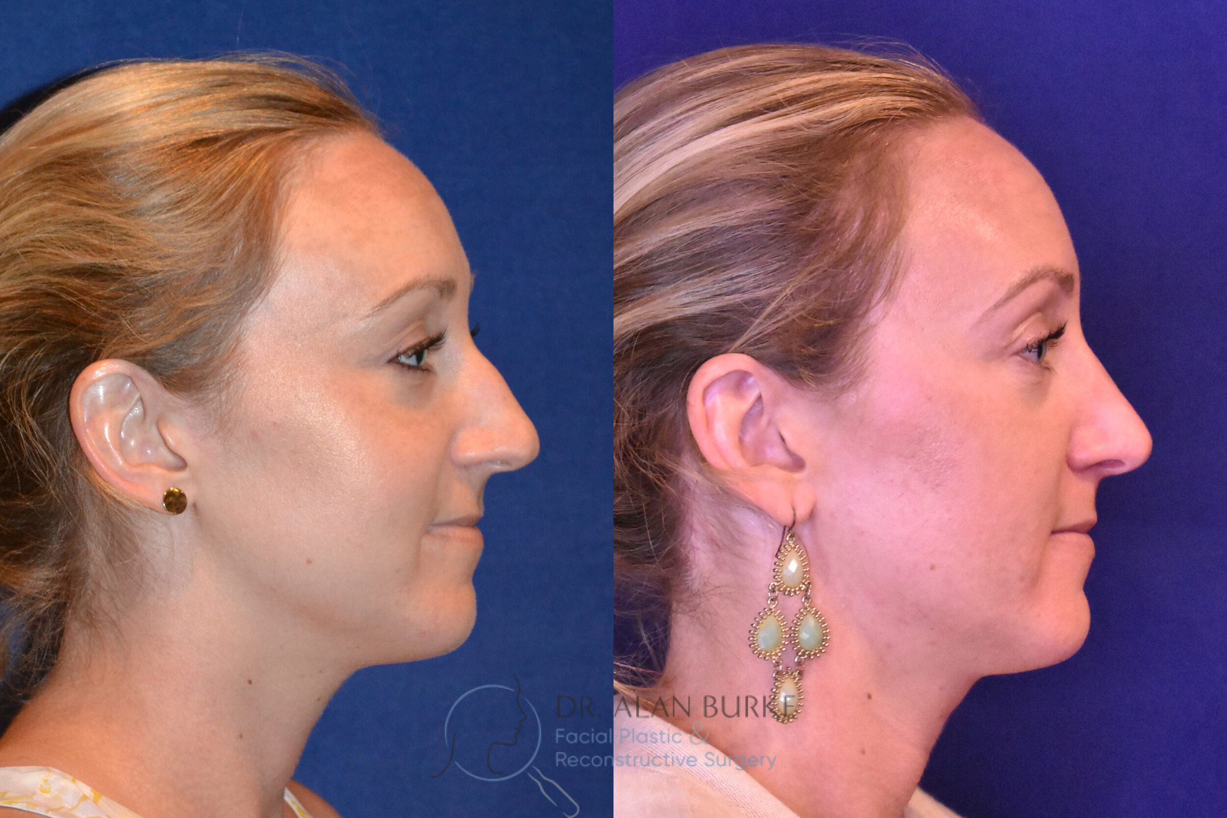 Before and After Image: Rhinoplasty - right-side