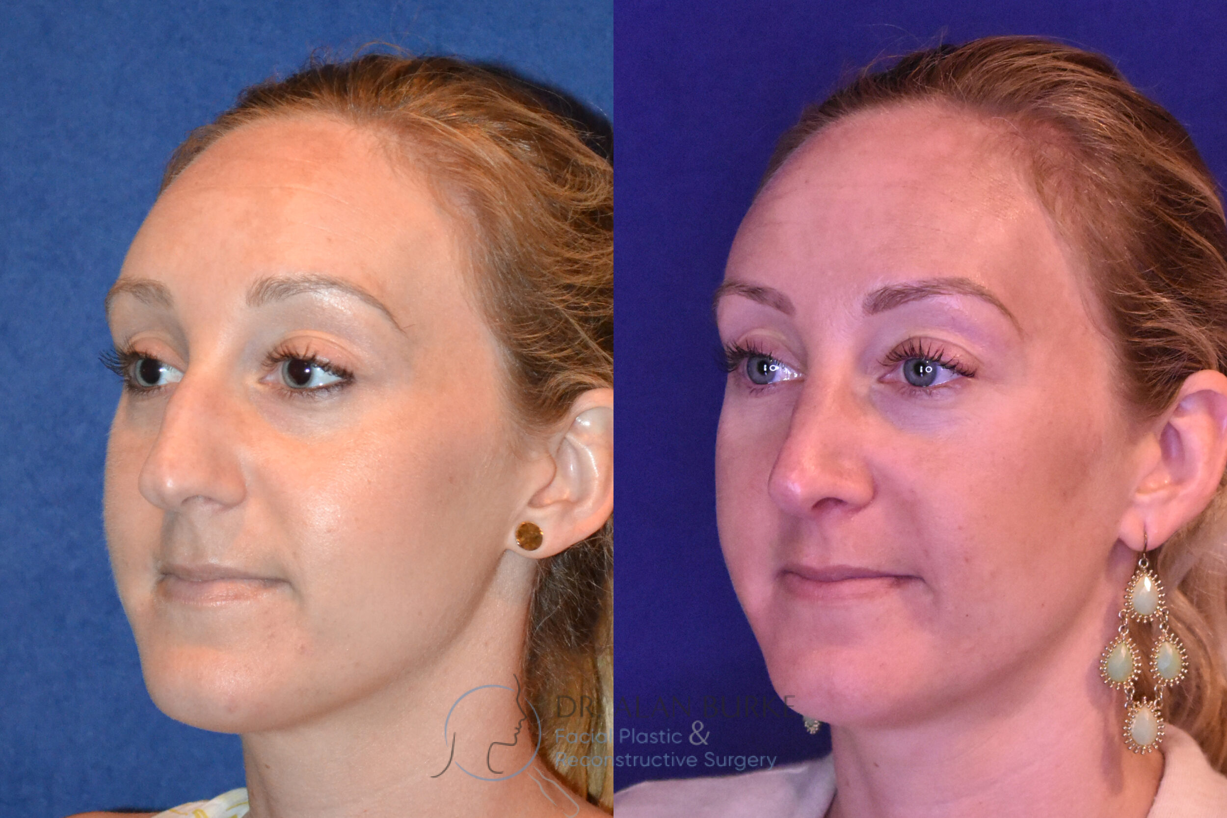 Before and After Image: Rhinoplasty - left-front-oblique