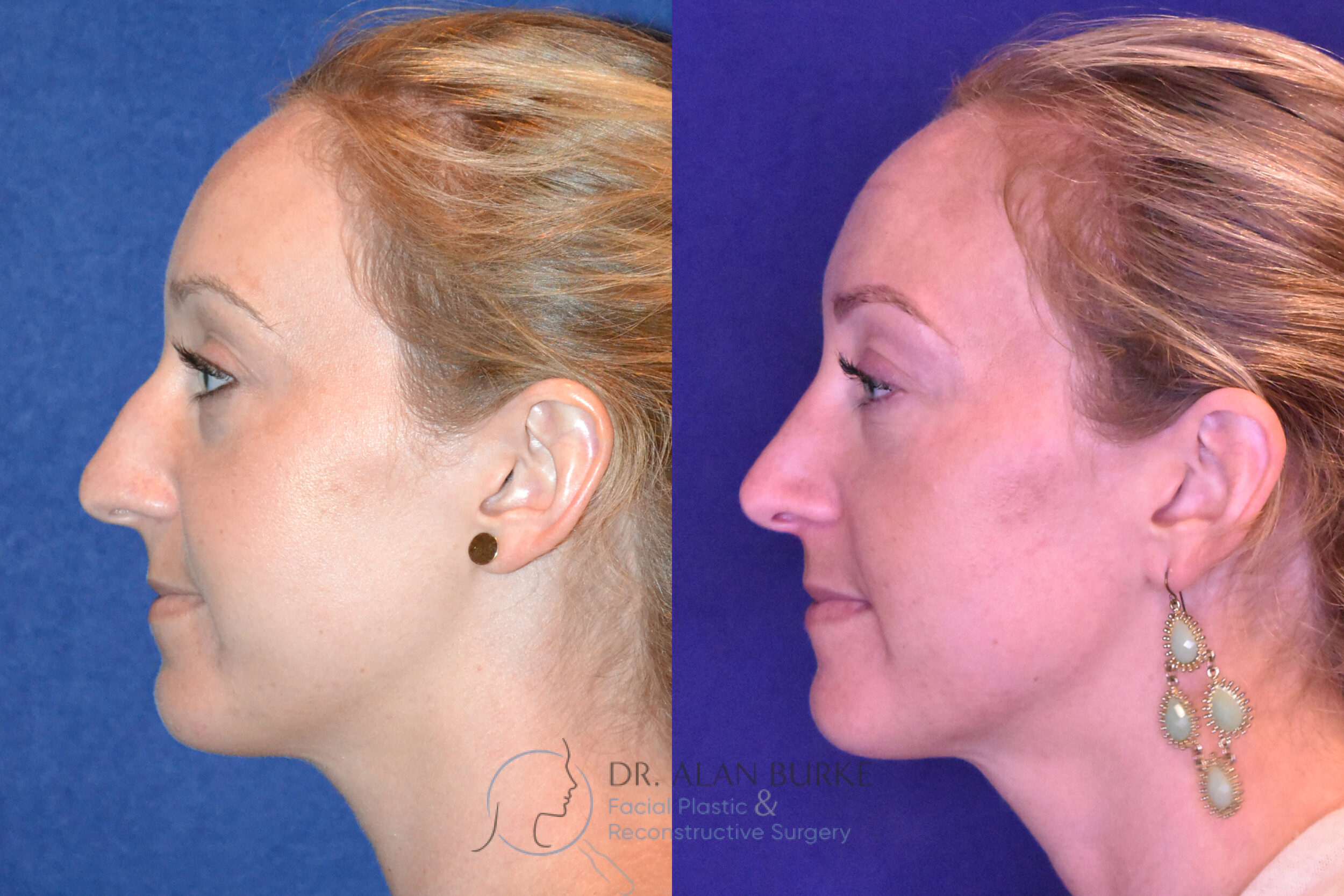 Before and After Image: Rhinoplasty - left-side
