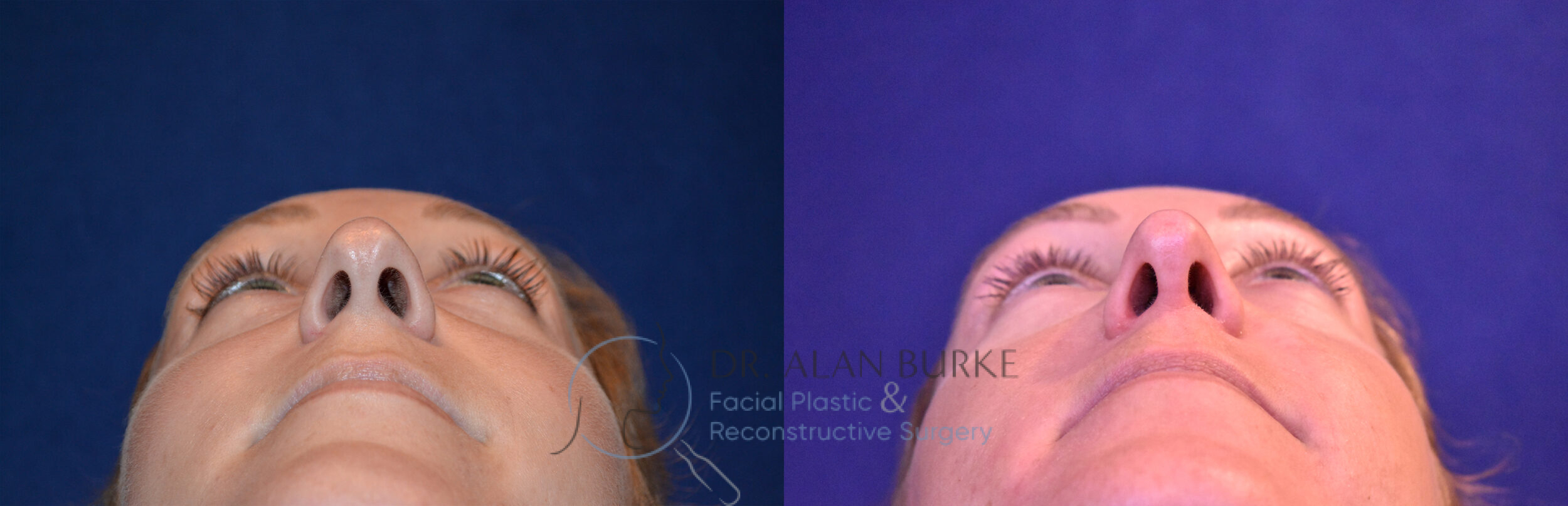 Before and After Image: Rhinoplasty - other