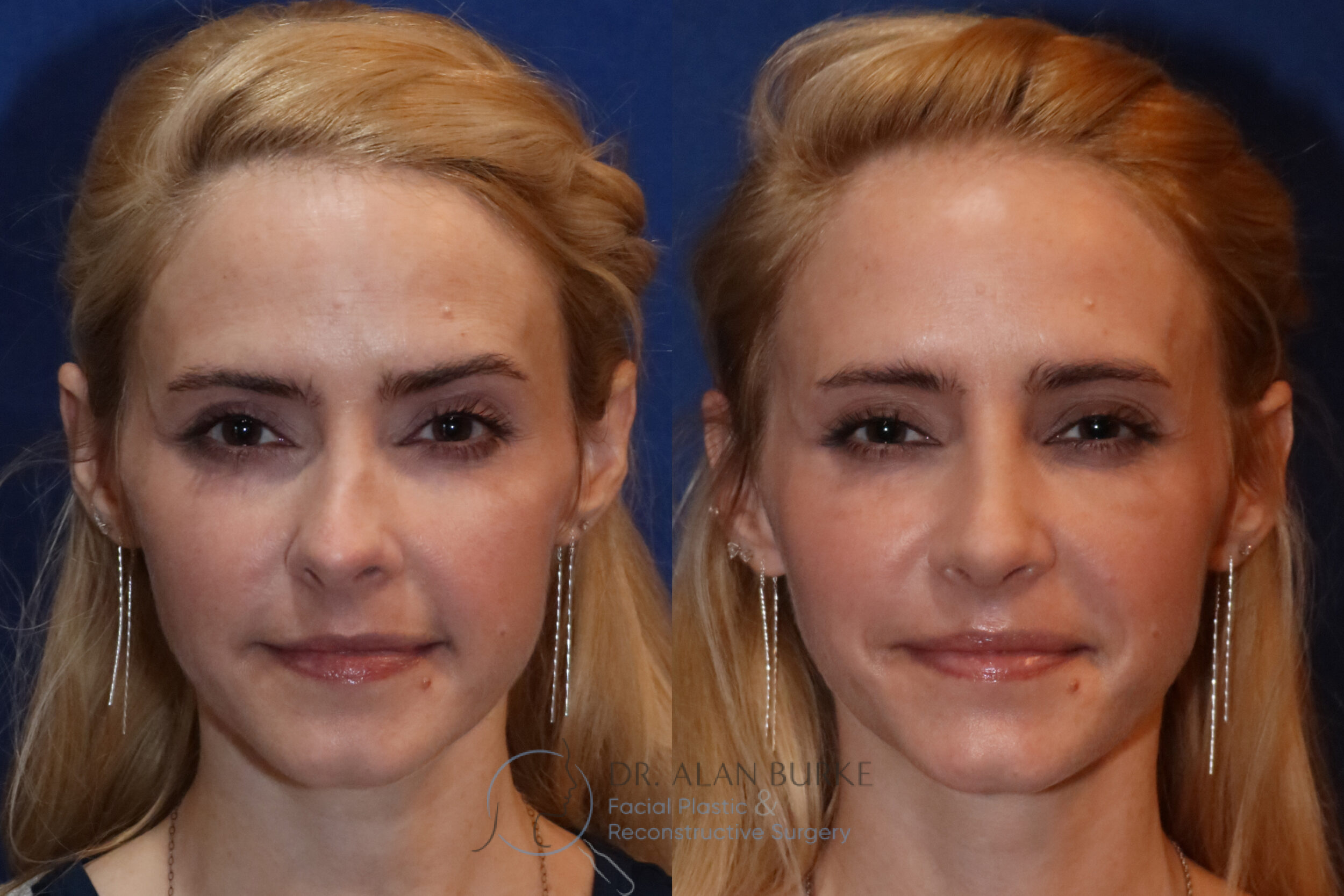 Before and After Image: Rhinoplasty - front