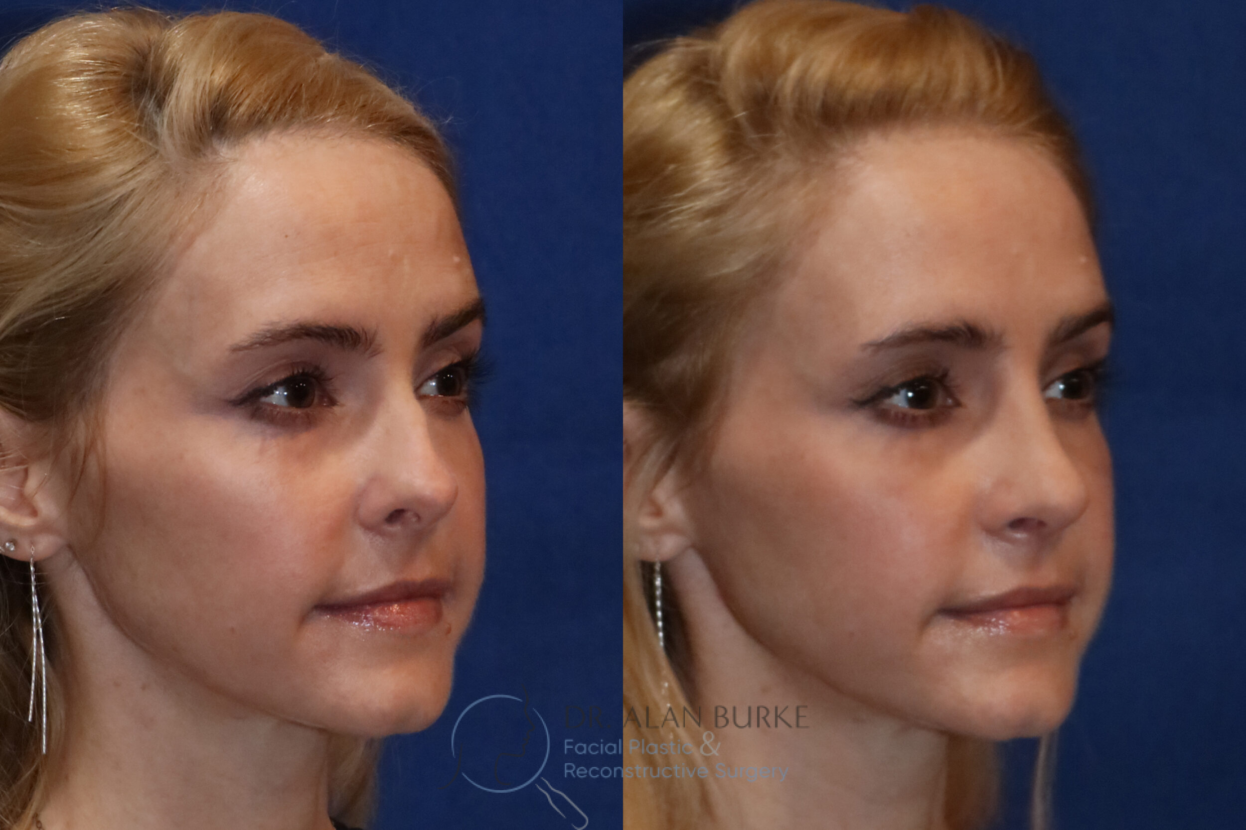 Before and After Image: Rhinoplasty - right-front-oblique