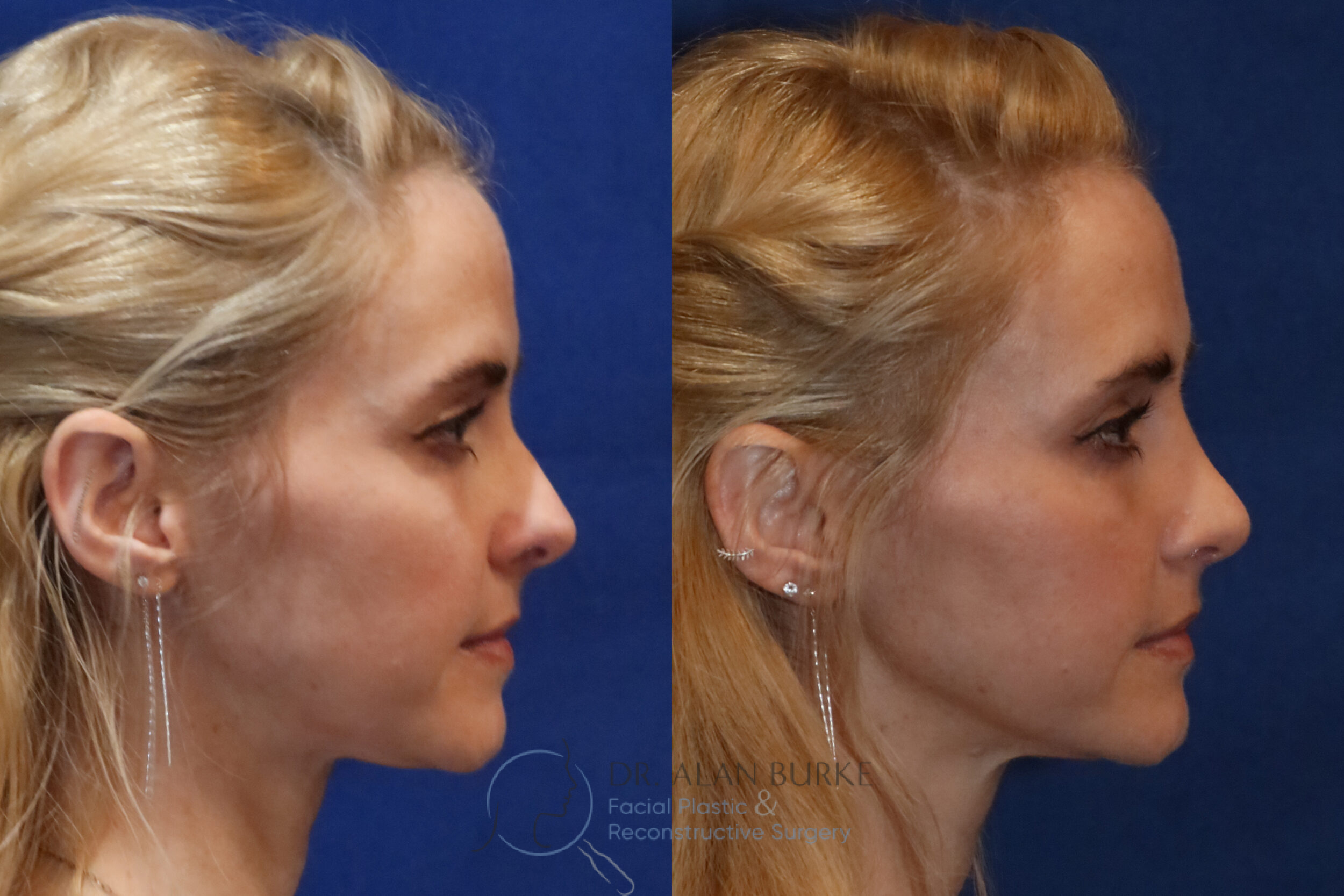Before and After Image: Rhinoplasty - right-side