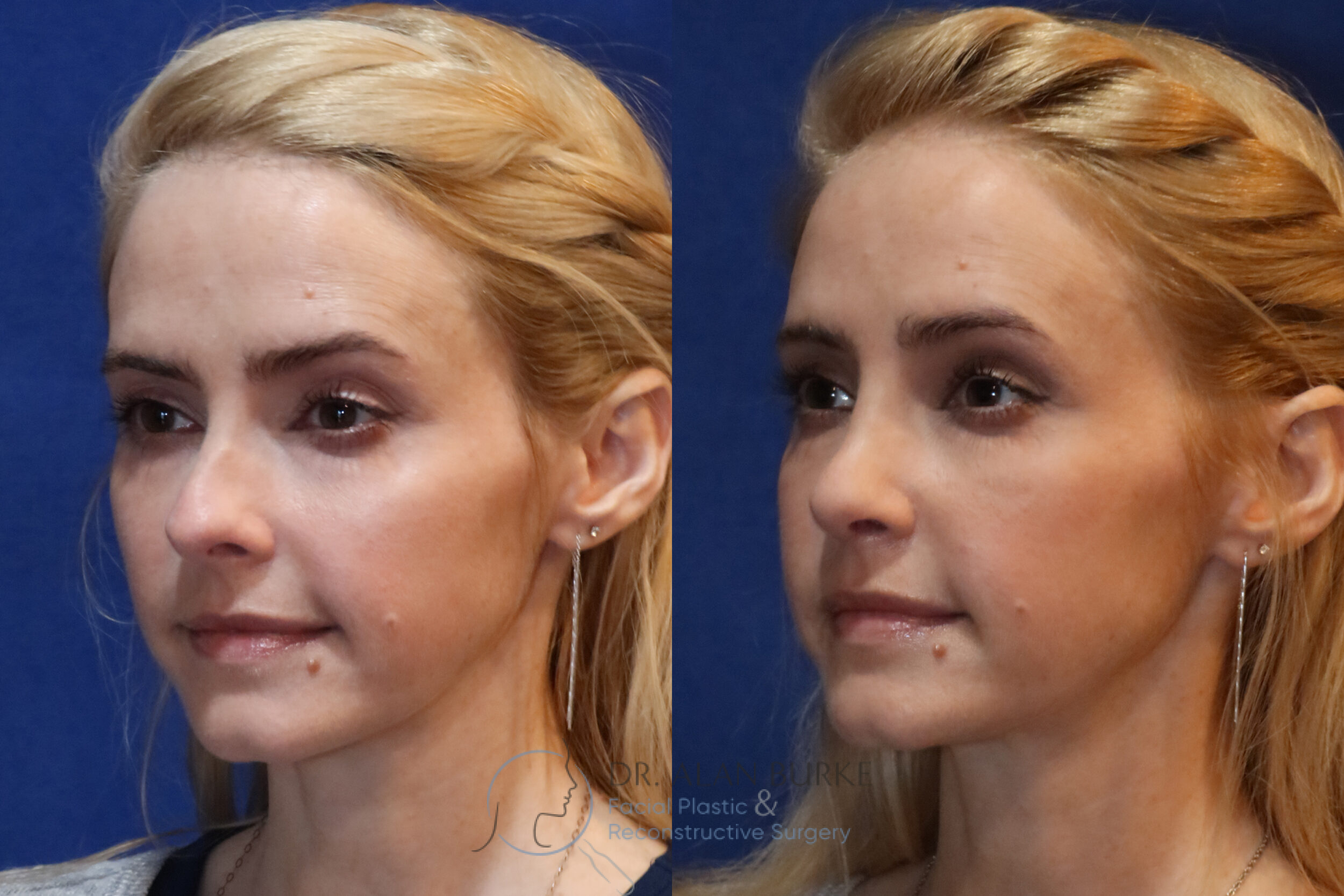 Before and After Image: Rhinoplasty - left-front-oblique