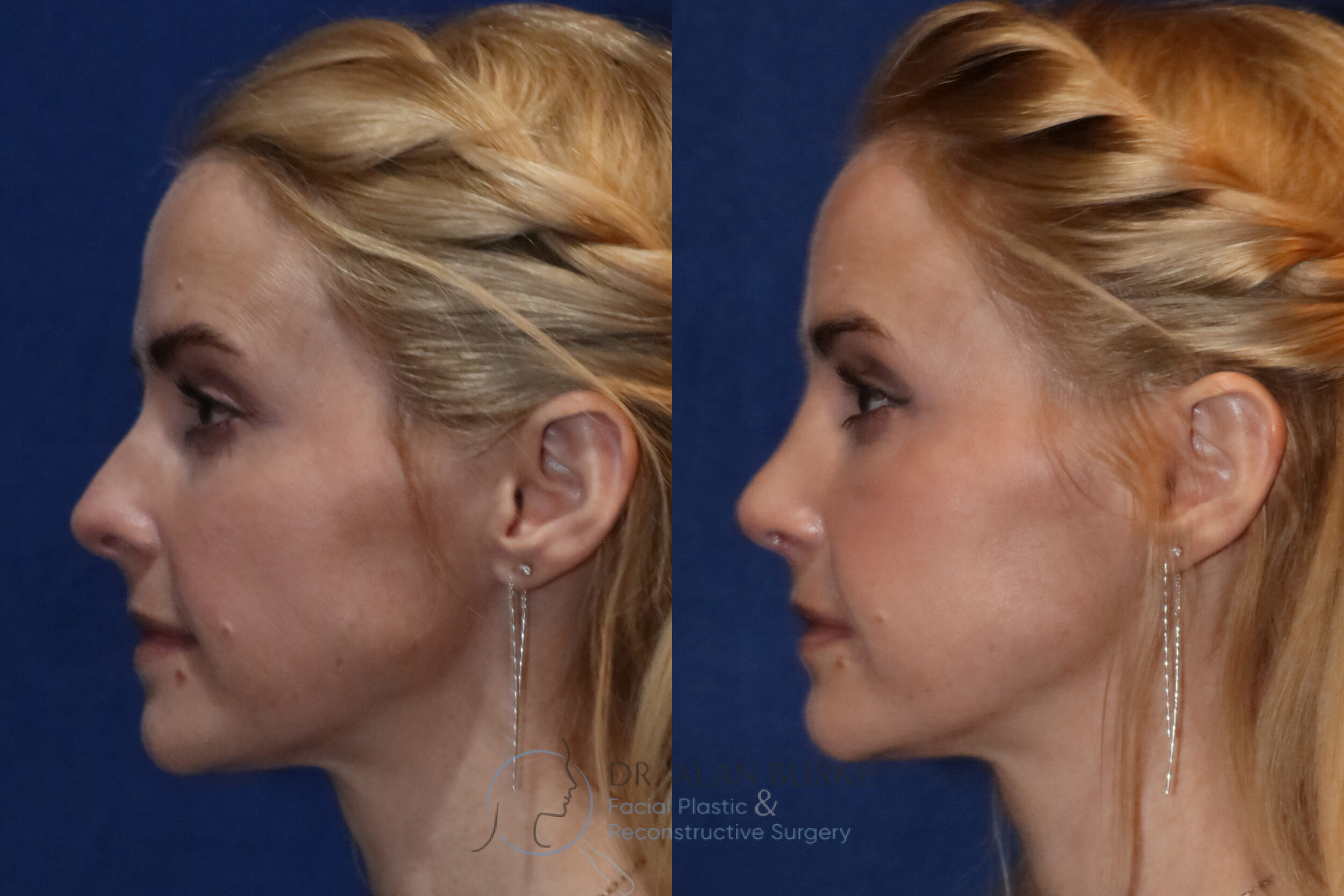 Before and After Image: Rhinoplasty - left-side