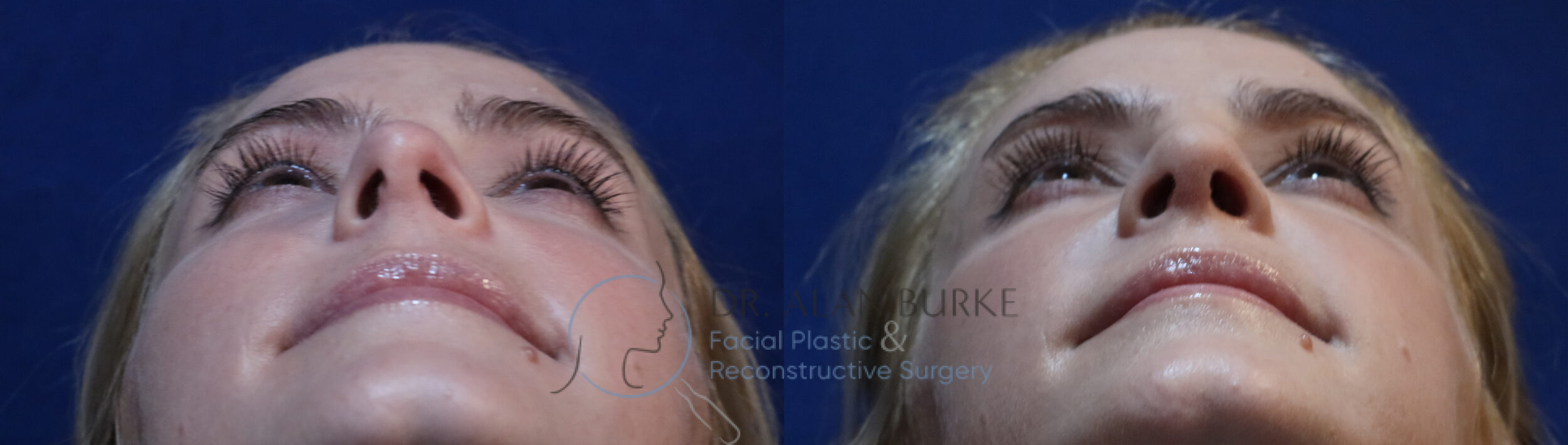 Before and After Image: Rhinoplasty - other