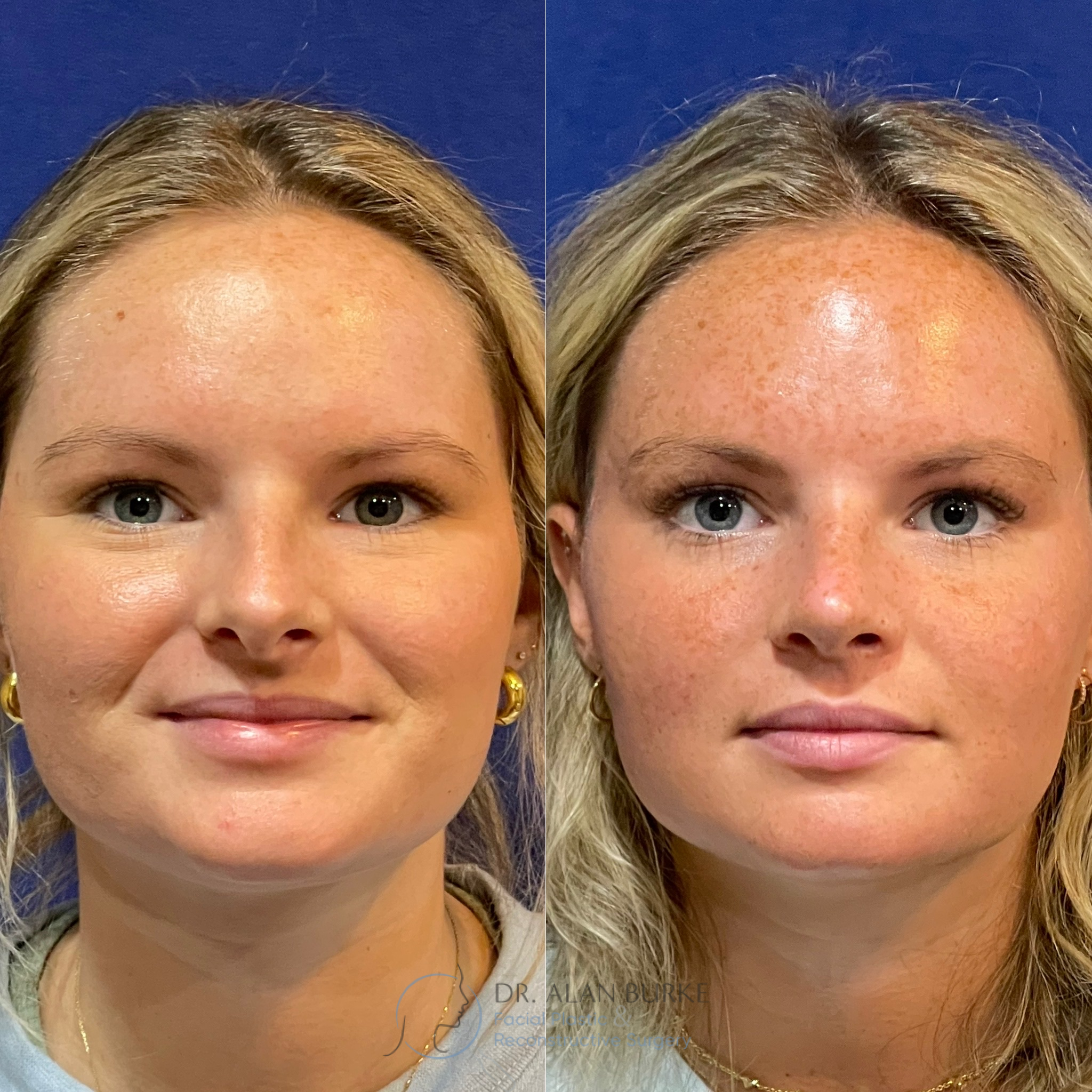 Before and After Image: Rhinoplasty - front