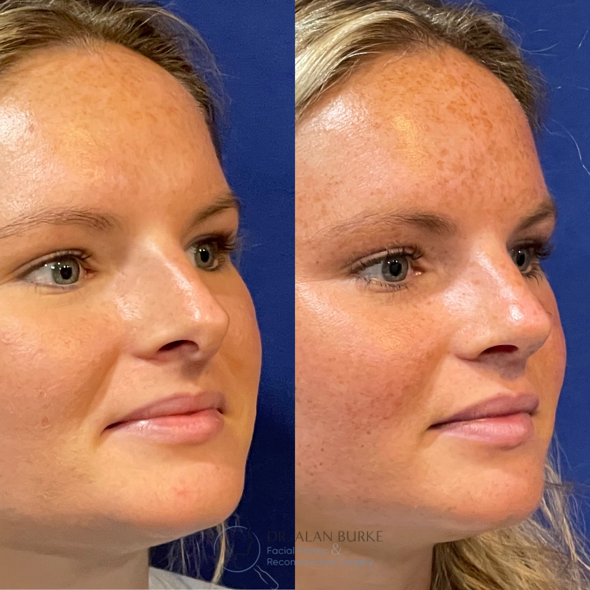 Before and After Image: Rhinoplasty - right-front-oblique