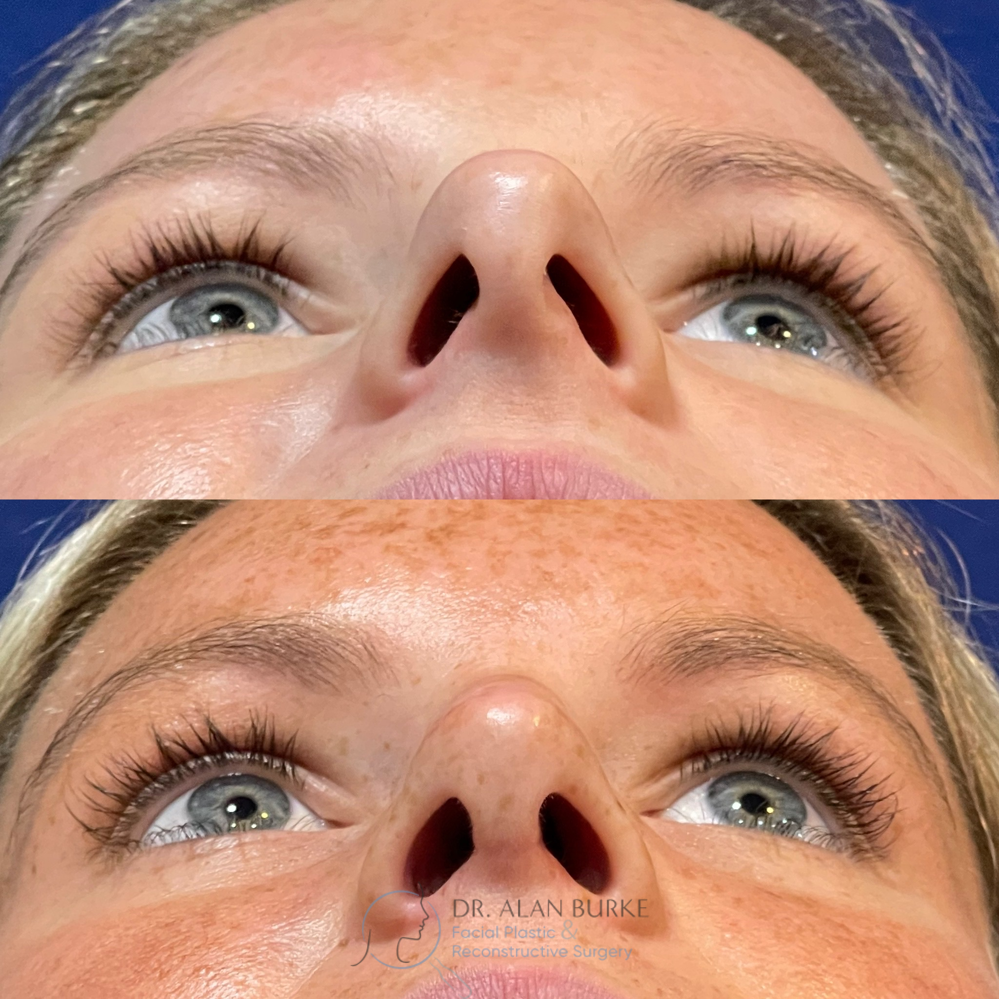 Before and After Image: Rhinoplasty - front