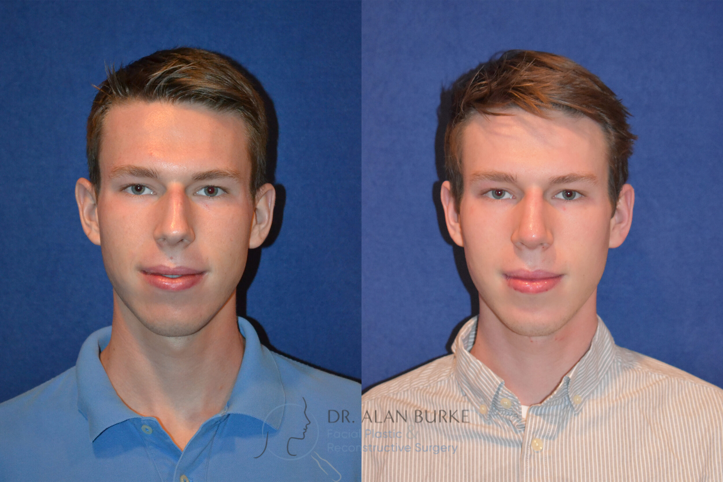 Before and After Image: Rhinoplasty - front