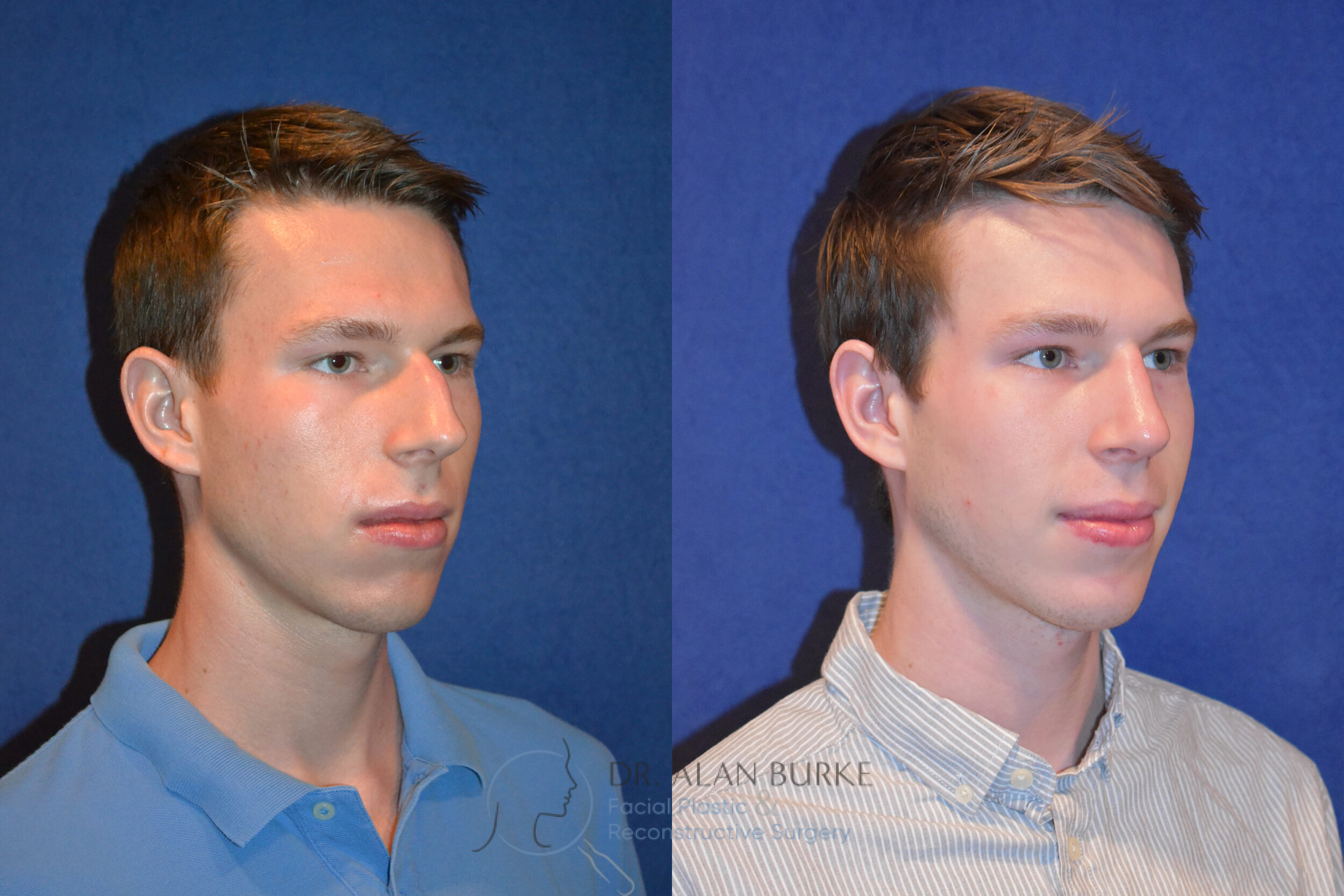Before and After Image: Rhinoplasty - right-front-oblique