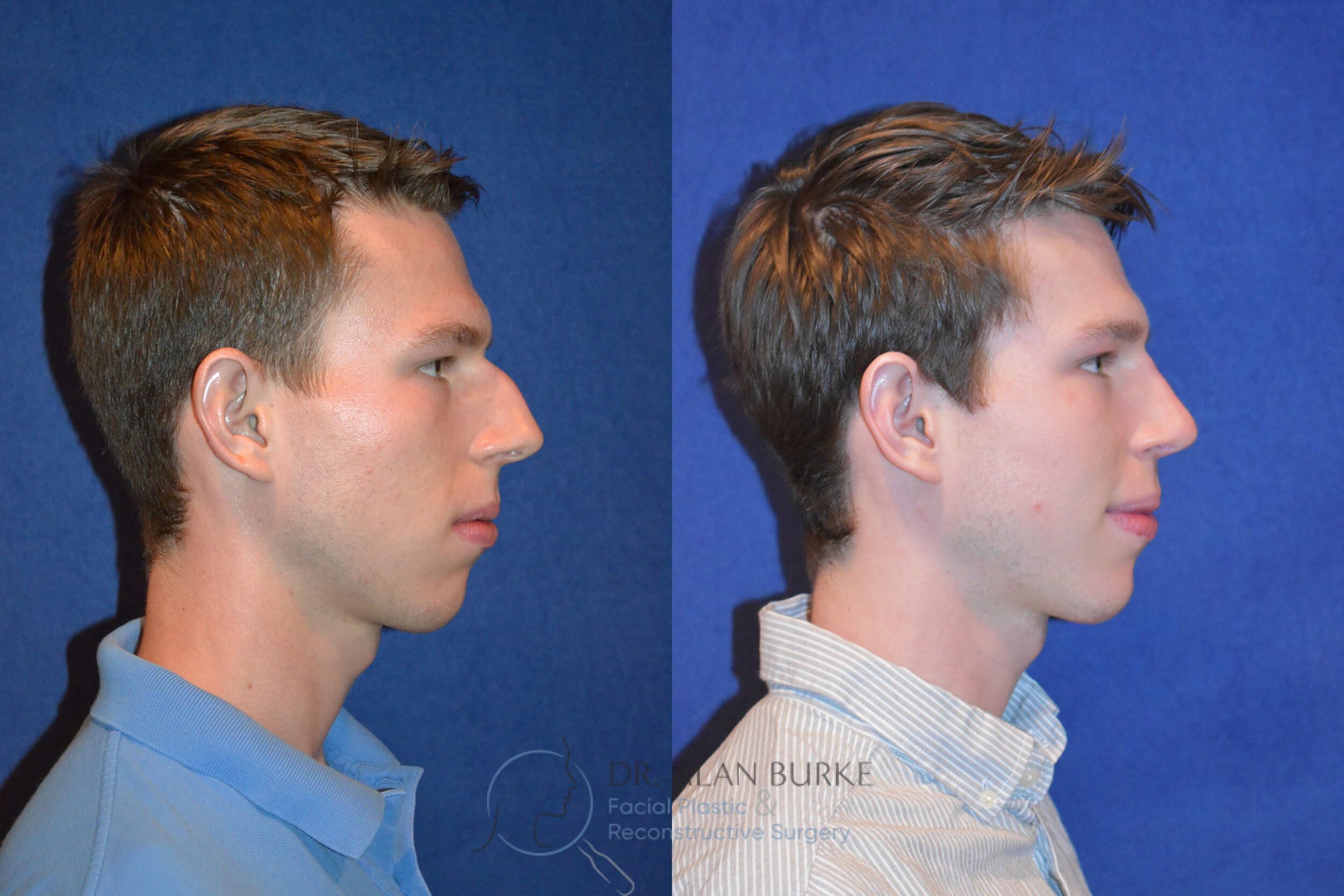 Before and After Image: Rhinoplasty - right-side