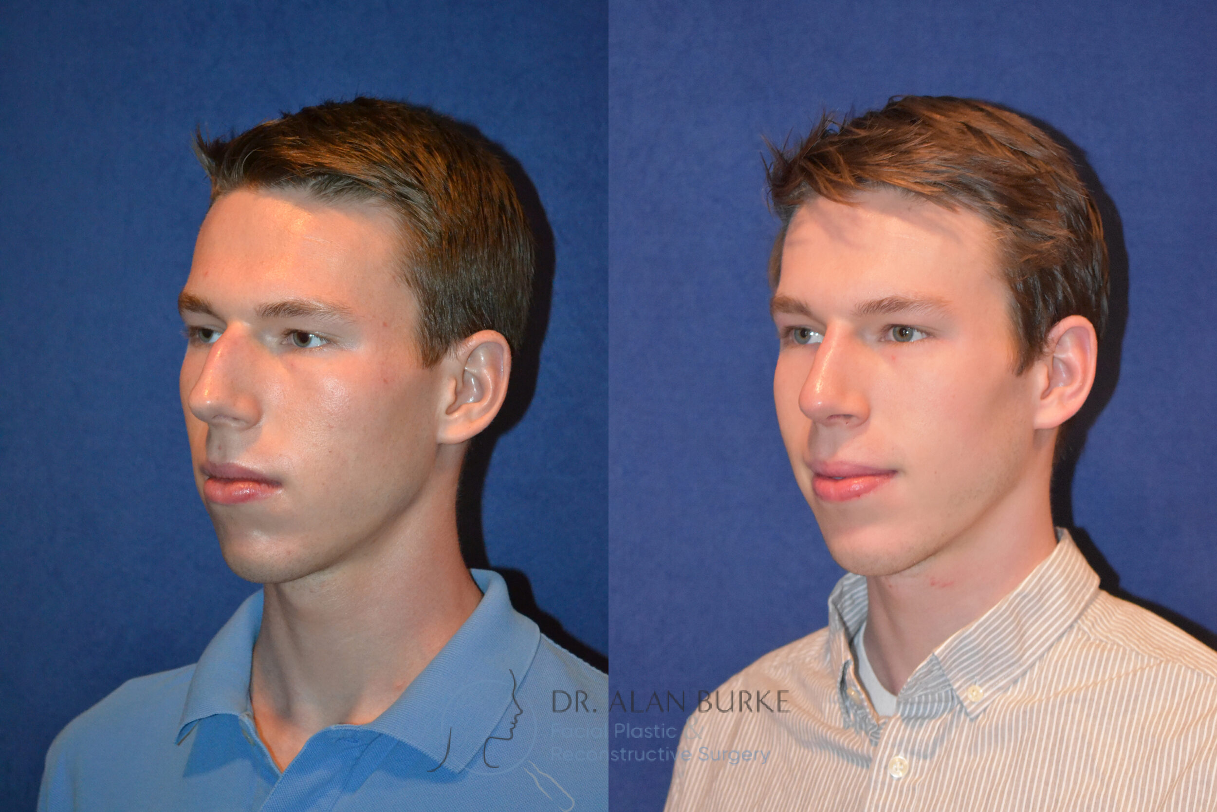 Before and After Image: Rhinoplasty - left-front-oblique