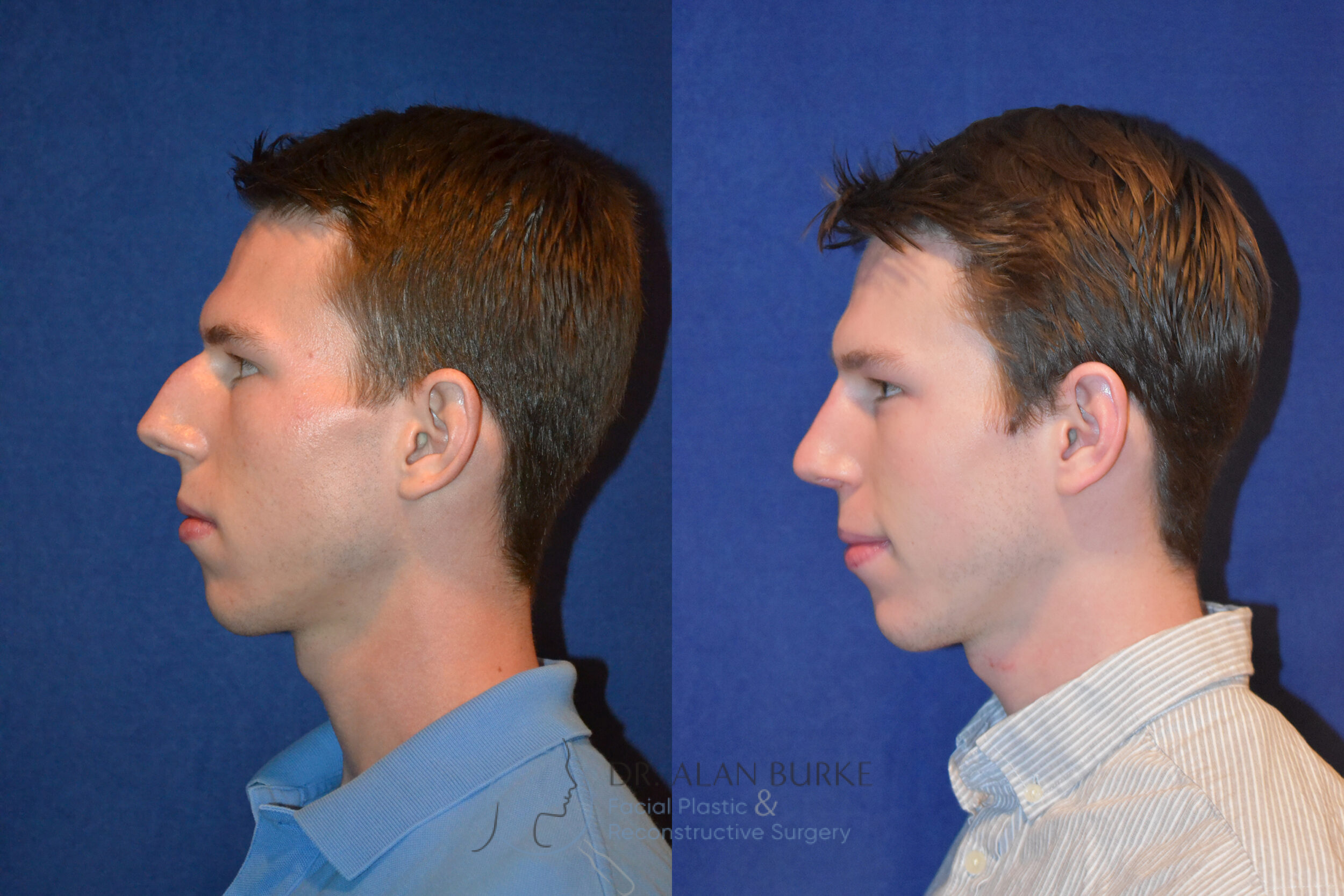 Before and After Image: Rhinoplasty - left-side