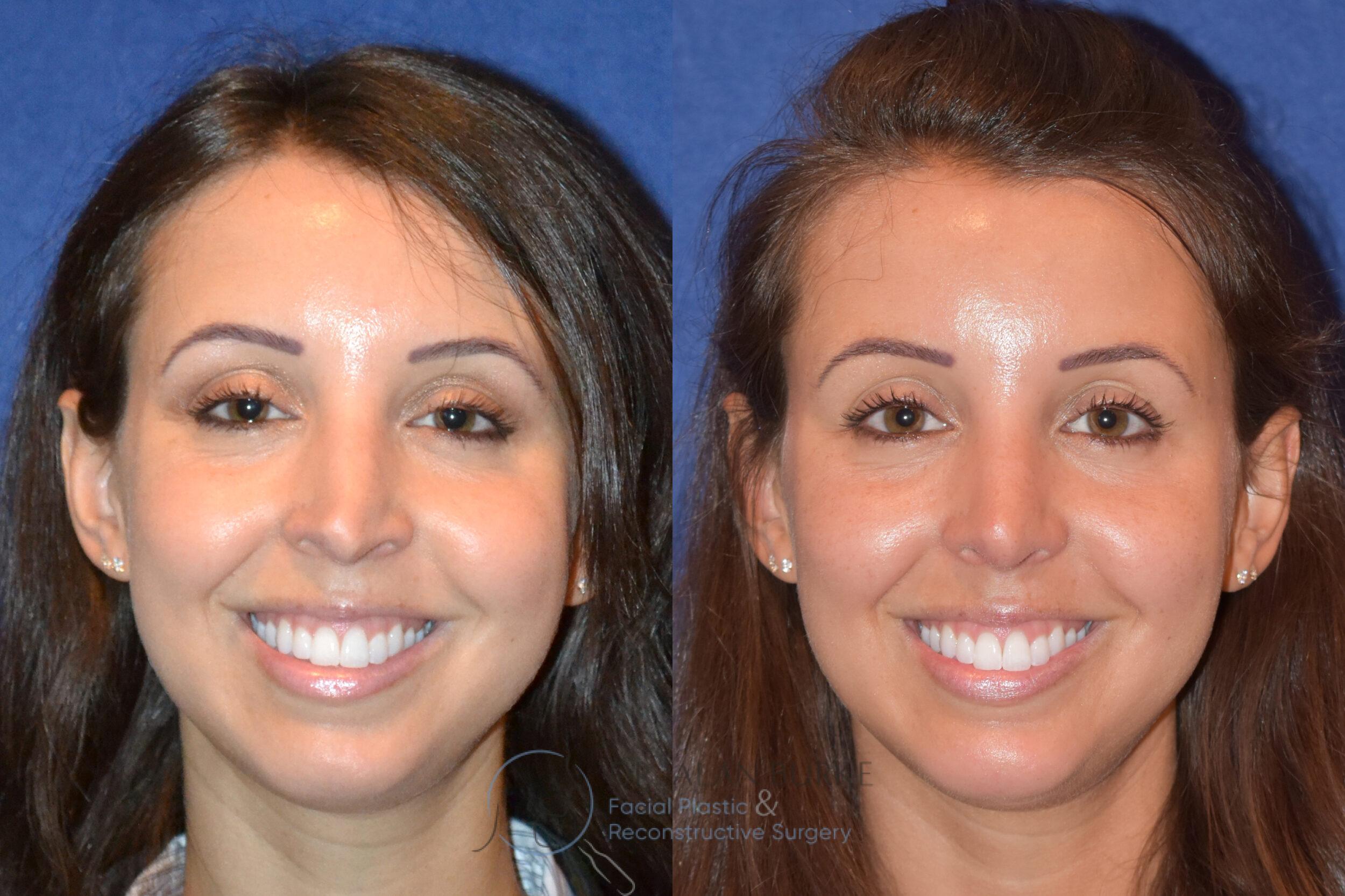 Before and After Image: Rhinoplasty - front
