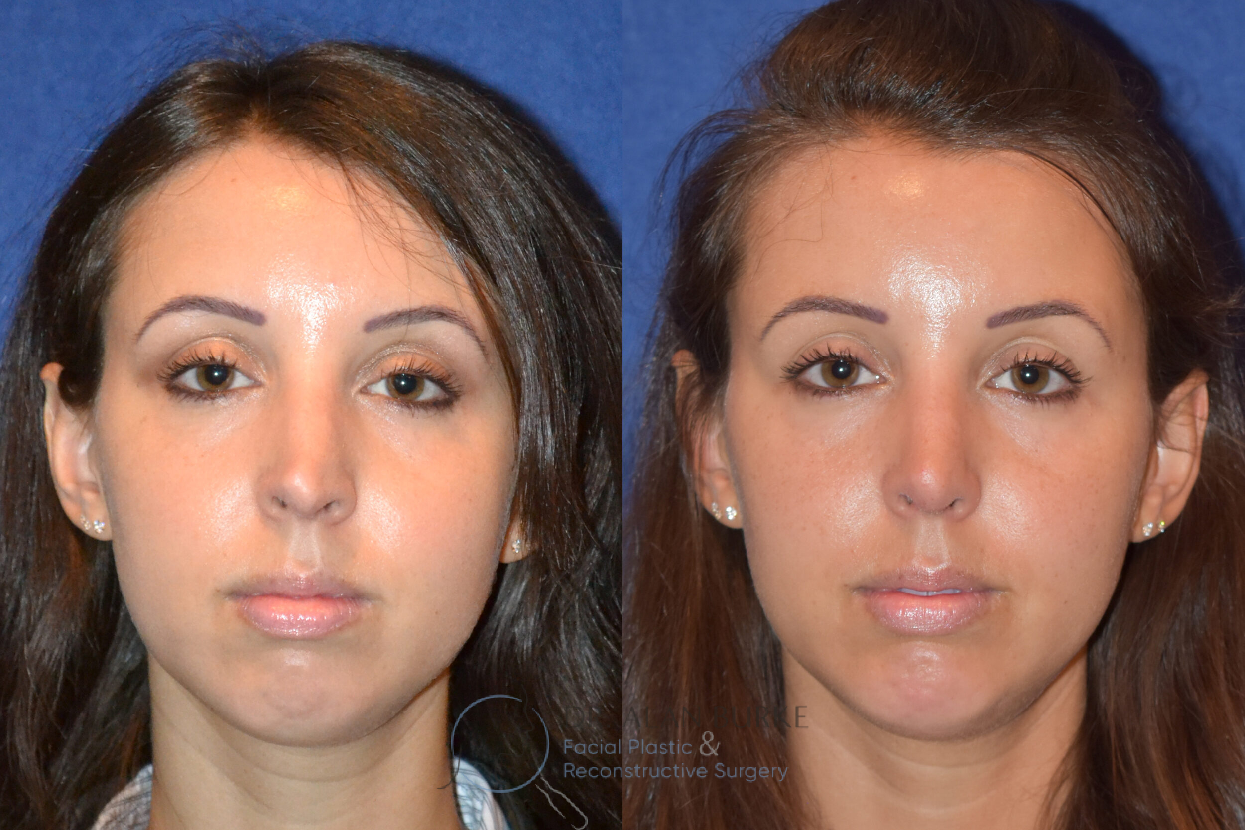 Before and After Image: Rhinoplasty - front