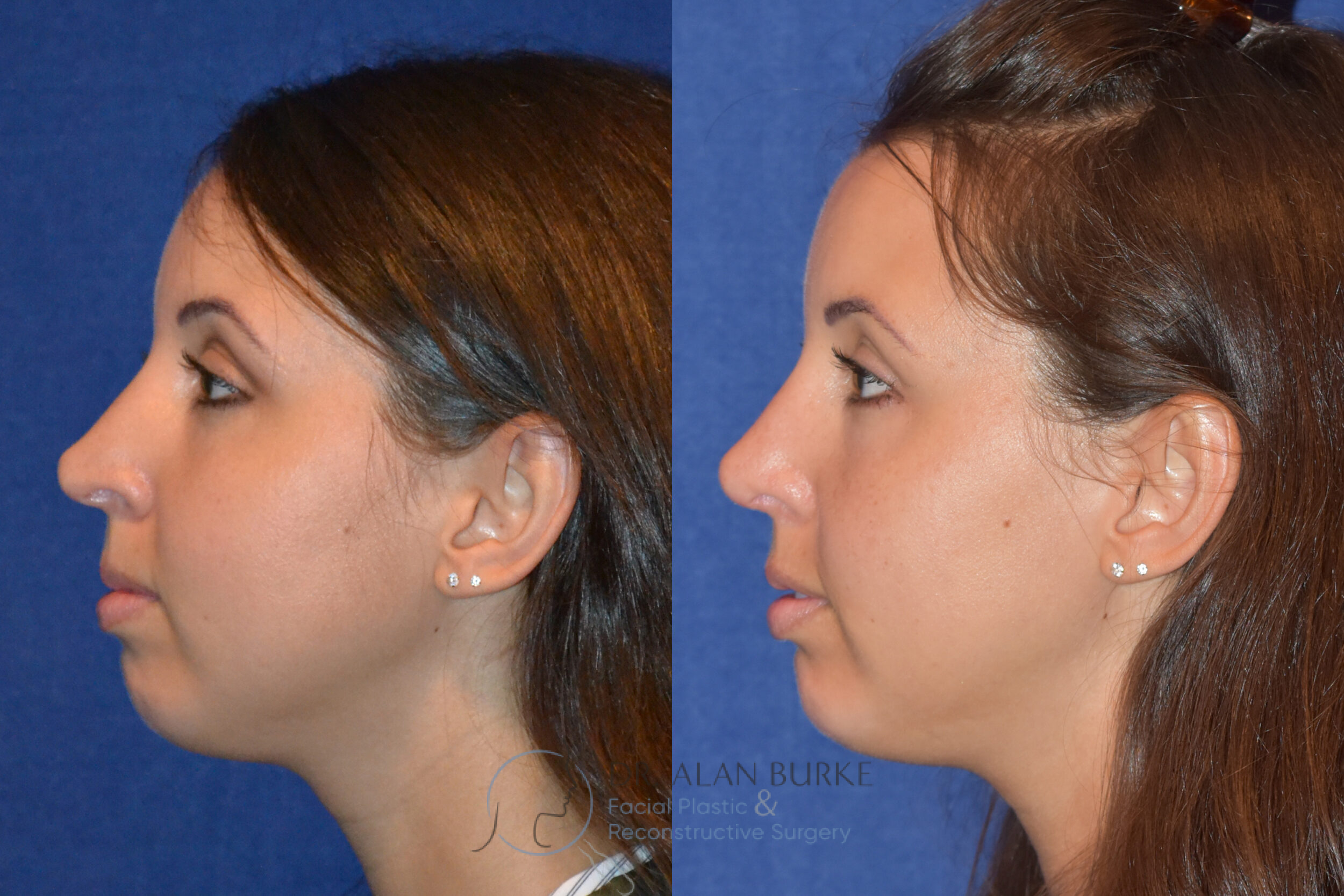 Before and After Image: Rhinoplasty - left-side