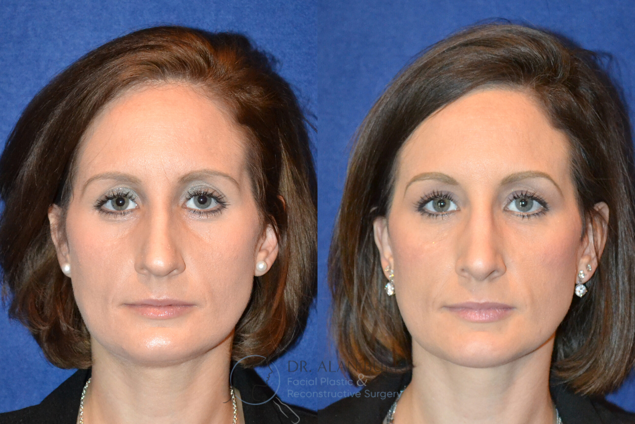 Before and After Image: Rhinoplasty - front