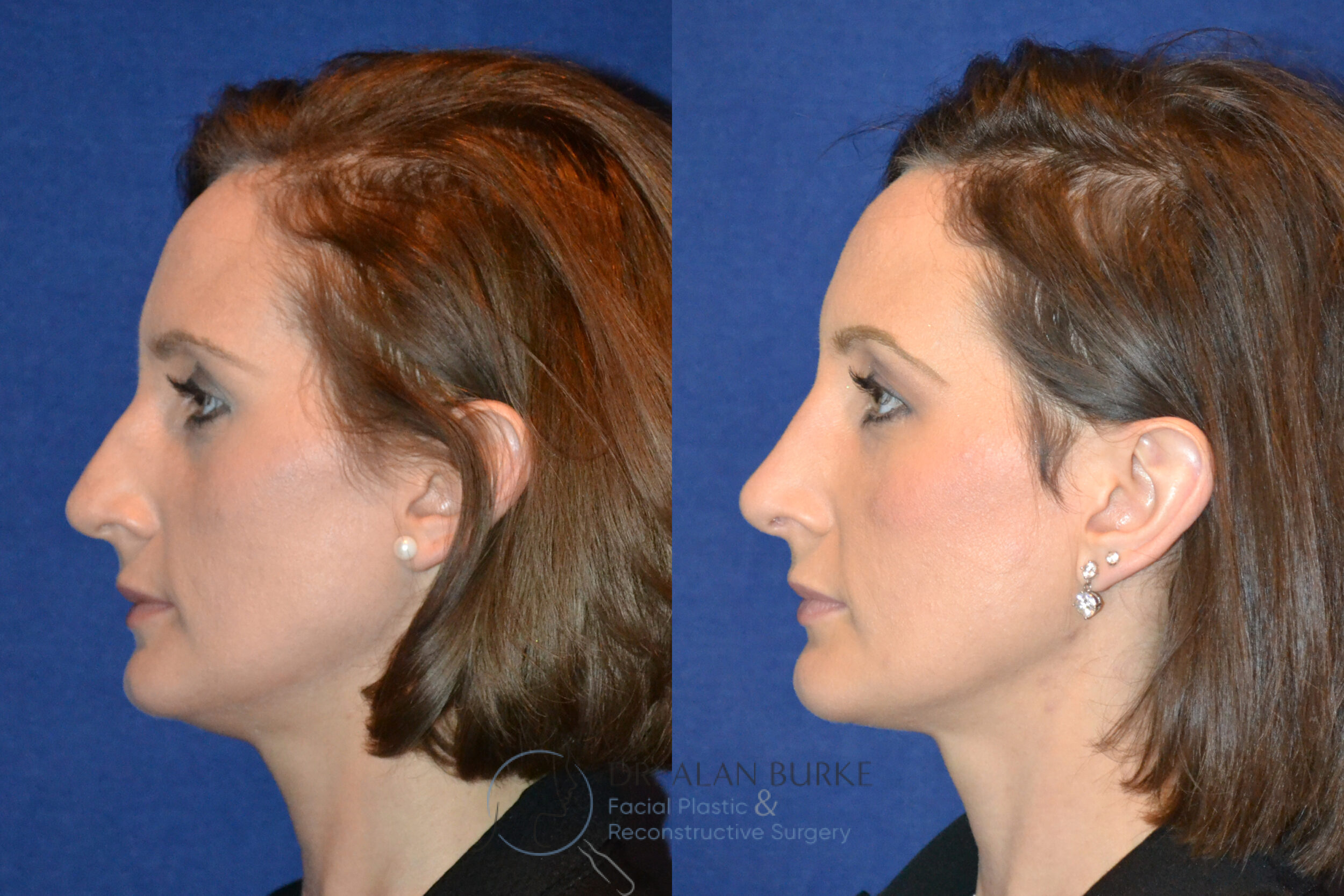 Before and After Image: Rhinoplasty - left-side