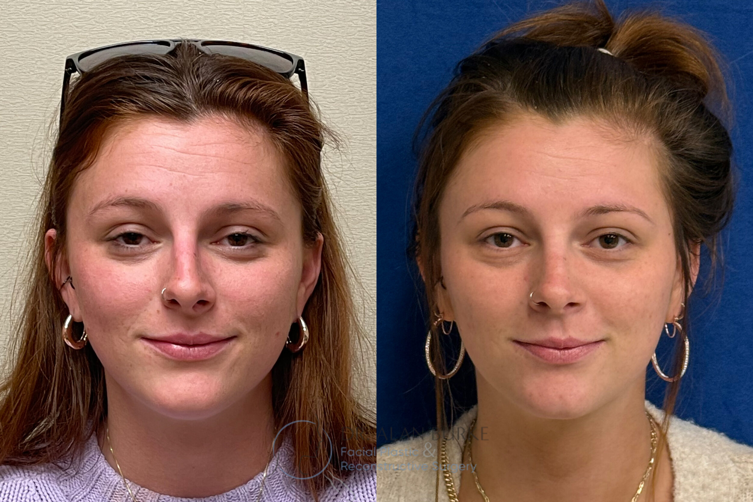 Before and After Image: Rhinoplasty - front
