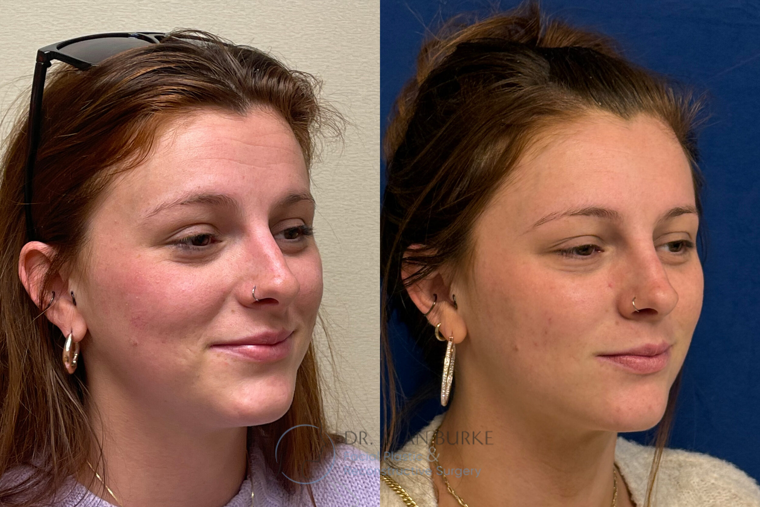 Before and After Image: Rhinoplasty - right-front-oblique