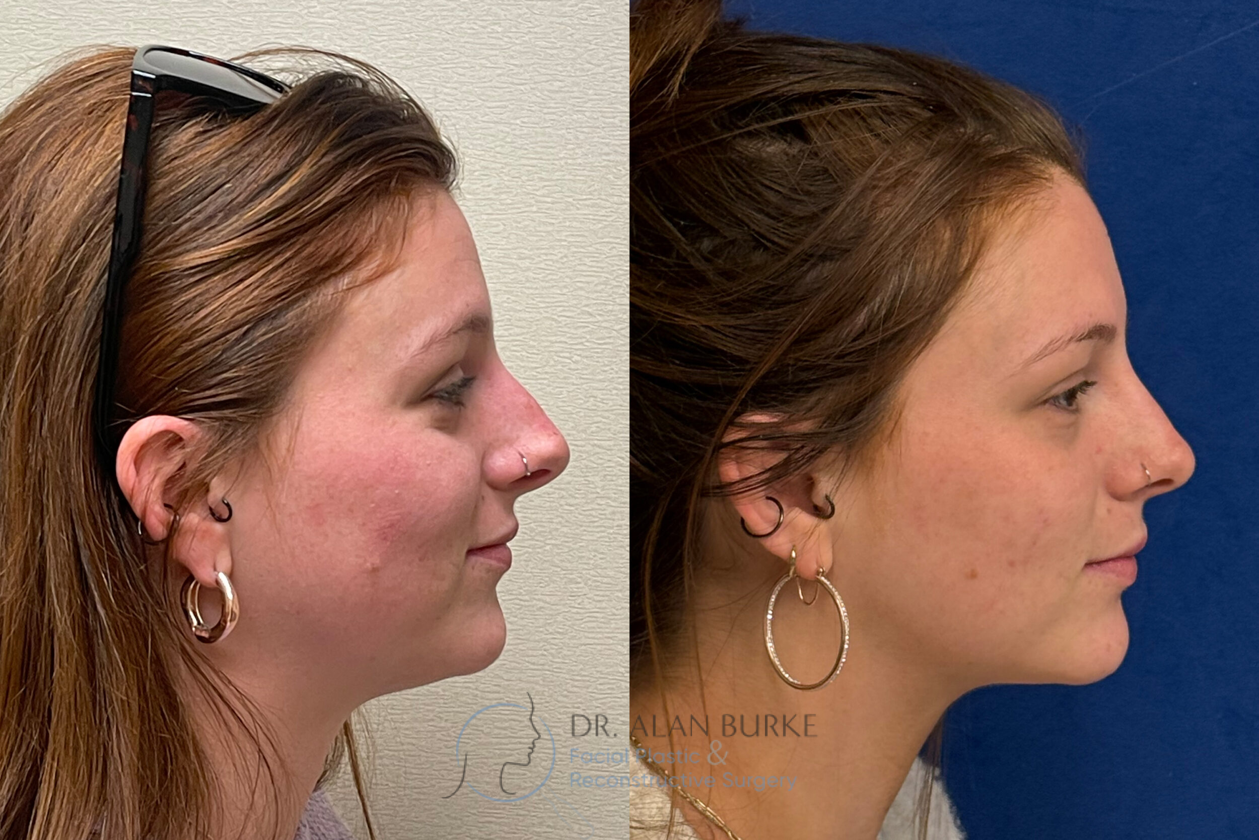 Before and After Image: Rhinoplasty - right-side